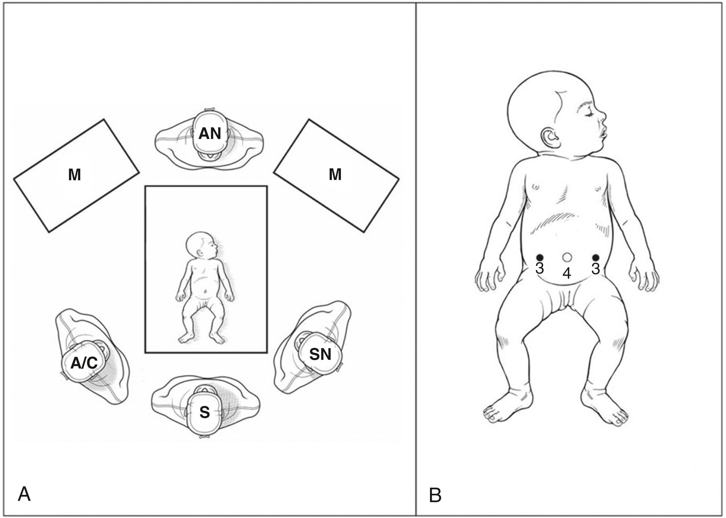 Fig. 12-2, A, Room setup for a laparoscopic or laparoscopic-assisted resection of an intestinal lesion is depicted. The infant is positioned at the foot of the bed with the surgeon at the foot of the table. The main monitor is near the head of the table. If the lesion is in the right or left colon, the surgeon is on the opposite side of the table. A/C, assistant/camera operator; S, surgeon; SN, scrub nurse; AN, anesthesiologist; M, monitors. B, Port placement for intracorporeal resection and anastomosis of an intestinal lesion is shown. If the lesion is colonic, the cannulas are shifted to triangulate the lesion.