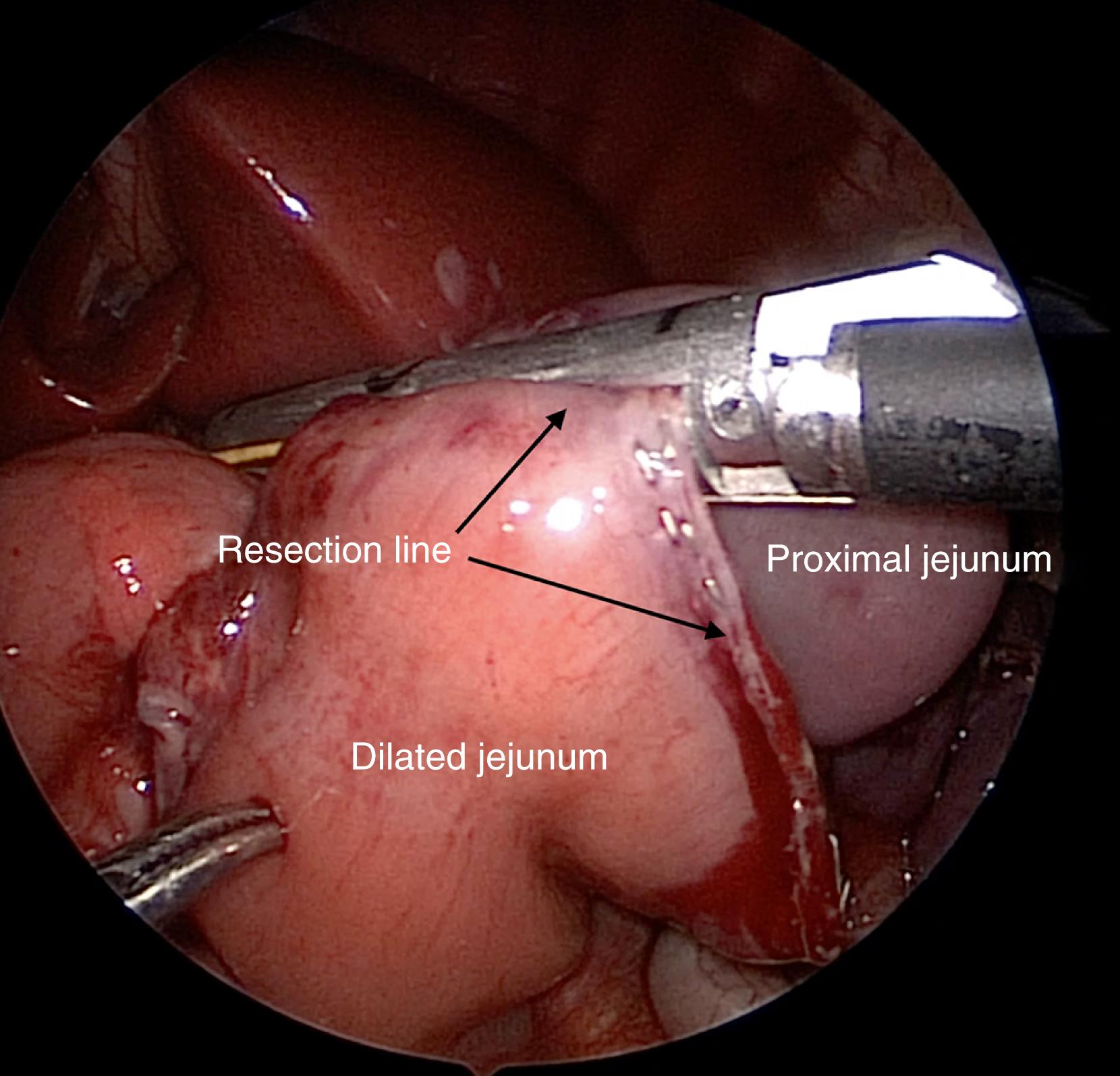 Fig. 12-3, Grossly dilated jejunum is being resected in a baby with a proximal jejunal atresia. In this case, the 5-mm stapler is being used.