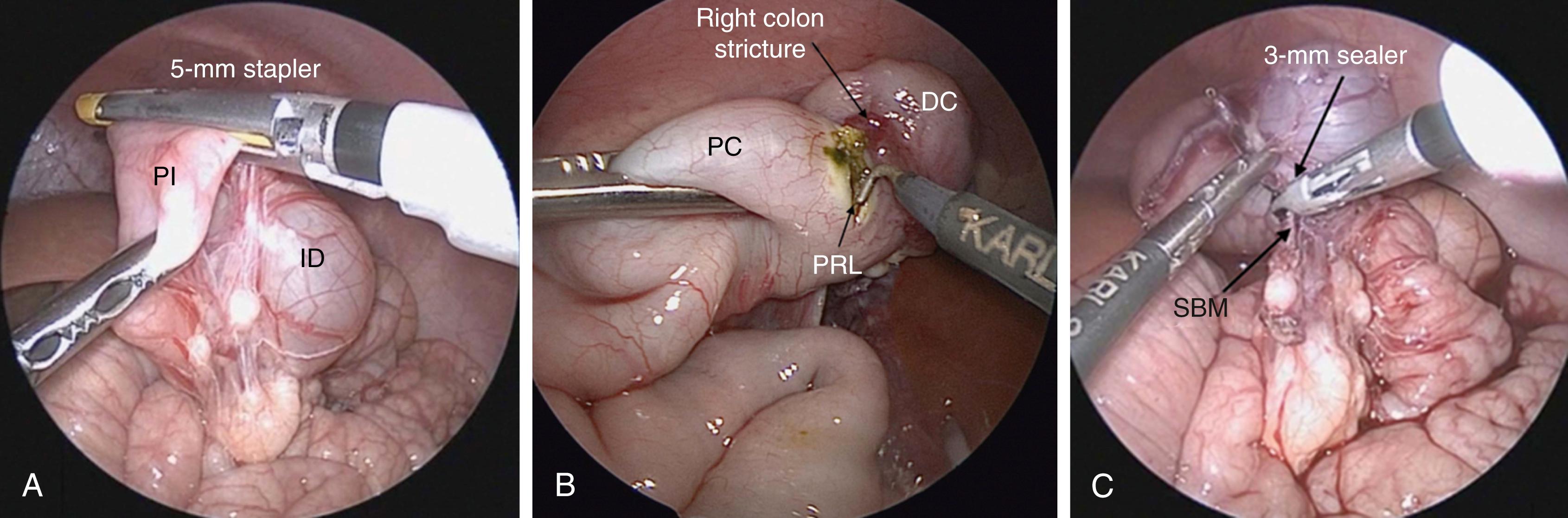 Fig. 12-4, A, An intestinal duplication (ID) in the midileum is seen. The ileum proximal (PI) to the duplication is being divided with the 5-mm stapler. B, A necrotizing enterocolitis (NEC) stricture in the distal right colon is seen. A hook cautery is used to divide the right colon proximal (PRL) to the stricture. A similar division is made distal to the stricture on the distal colon (DC). C, A 3-mm vessel sealer is being used to strip off the small bowel mesentery (SBM) of an intestinal duplication.