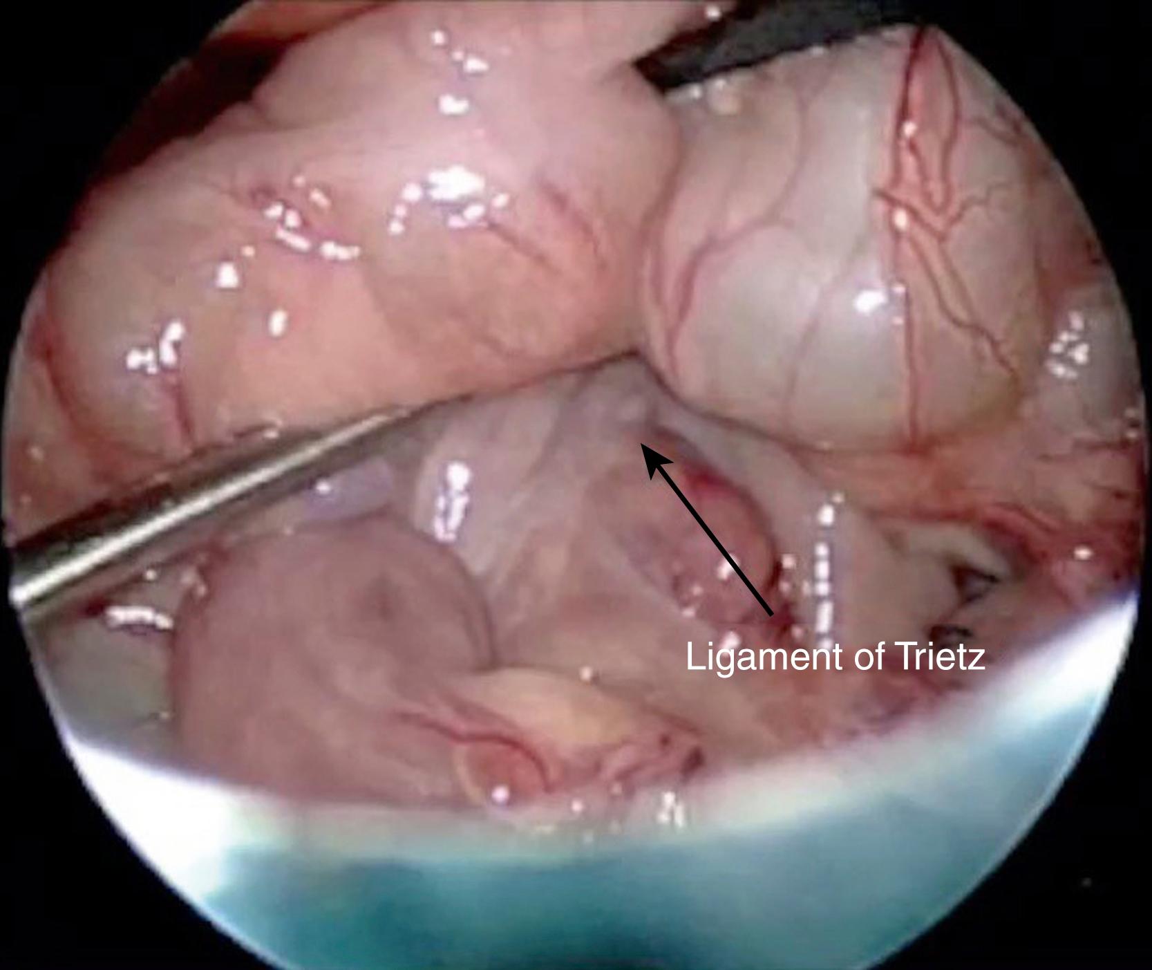 Fig. 7-2, At times, the upper gastrointestinal study can be equivocal for malrotation (see Fig. 7-1). In such patients, diagnostic laparoscopy is a useful technique to ascertain whether the patient actually has malrotation. The ligament for Treitz (arrow) is seen to be to the left of the patient’s midline.