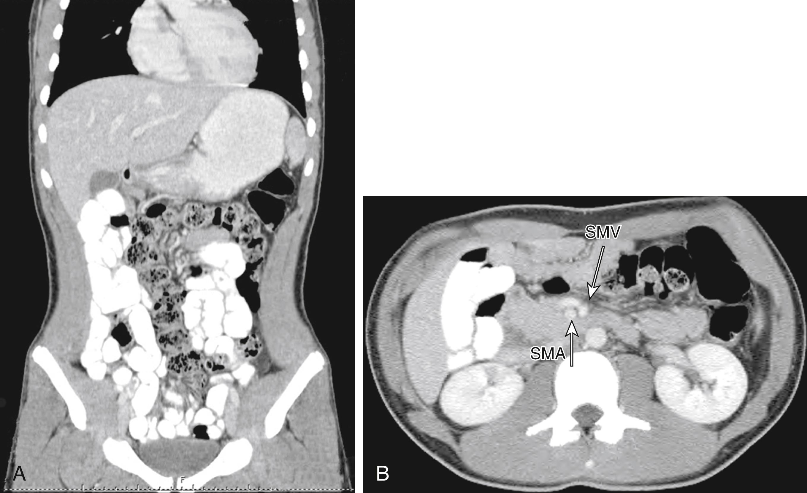 Fig. 7-3, This 15-year-old patient presented with chronic abdominal pain and underwent a computed tomography scan for diagnosis. A, On the sagittal view, the small bowel is filled with contrast and is located along the right paracolic gutter. B, On coronal section, note that the superior mesenteric artery (SMA) and superior mesenteric vein (SMV) are mispositioned and are reversed in orientation to each other. This patient underwent a laparoscopic Ladd procedure with resolution of her symptoms.
