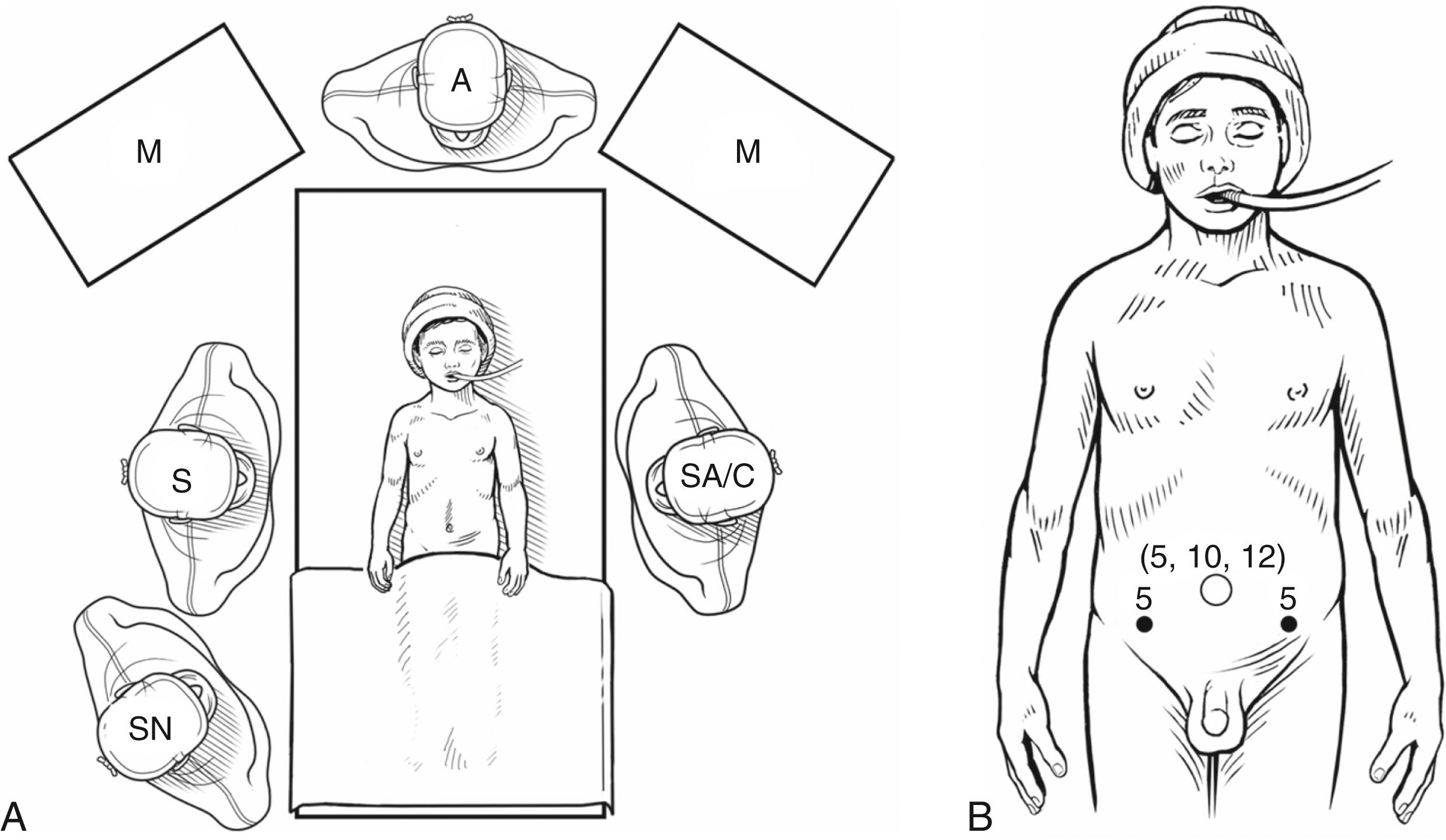 Fig. 7-4, A, Personnel placement for a laparoscopic Ladd procedure for a larger patient is shown. The child is placed supine on the operating table. The surgeon (S) usually stands to the patient’s right and the surgical assistant/camera holder (SA/C) is usually positioned opposite the surgeon. The scrub nurse (SN) is positioned to the surgeon’s right. For older patients, the lithotomy position may be preferred. In this situation, the surgeon is usually positioned between the patient’s legs. A, anesthesiologist; M, monitor. B, Port placement for a laparoscopic Ladd procedure. A 5- or 10- to 12-mm umbilical port is selected based on the patient’s size and intentions to perform a transumbilical appendectomy. Two 3- or 5-mm instruments are introduced through the anterior abdominal wall to triangulate the operative field. These incision sites are typically located in the right and left lower abdomen.