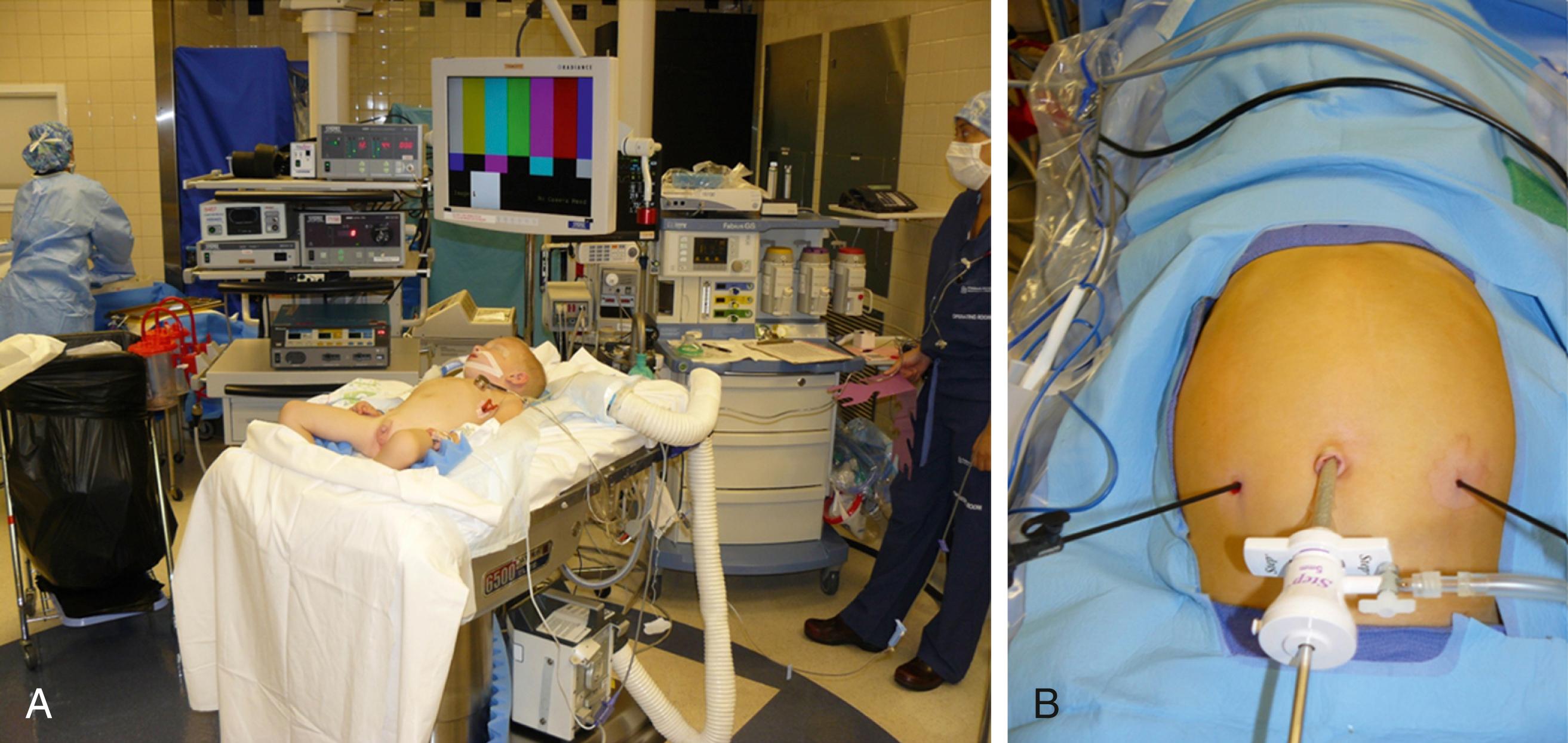 Fig. 7-5, A, An infant is positioned at the foot of the operating bed with the surgeon standing at the feet and the assistant to the right. The scrub nurse usually stands to the surgeon’s left. B, Port placement for a laparoscopic Ladd operation in an infant. A fourth 3-mm instrument can be introduced for retraction in the right or left upper abdomen, if needed.