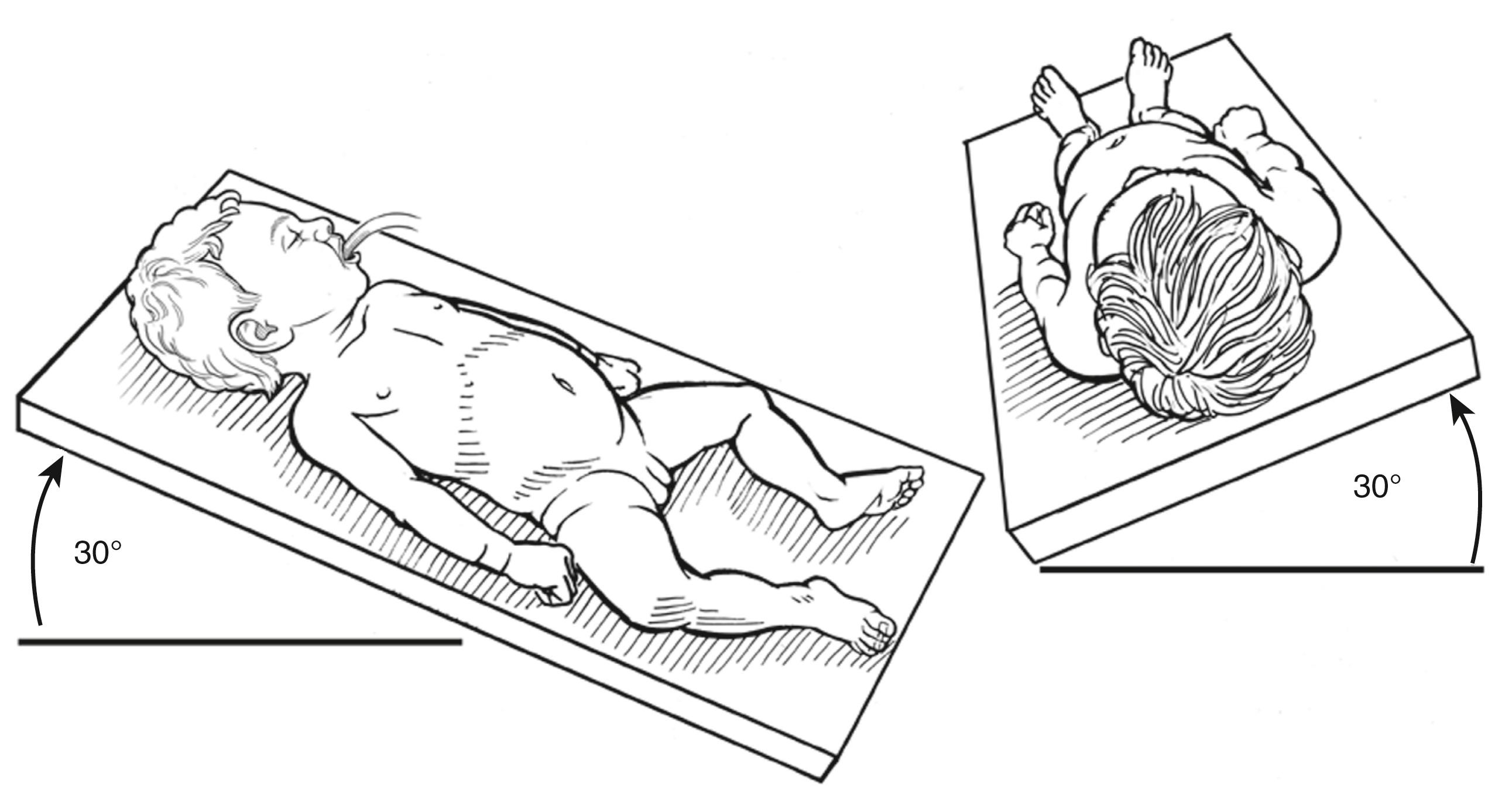 Fig. 7-6, After insertion of the ports and instruments, the patient is placed in reverse Trendelenburg and tilted about 30 degrees to the left to improve visualization of the right upper abdomen.