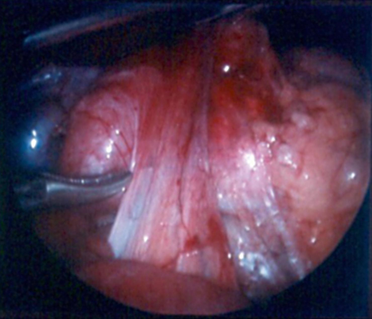 Fig. 7-8, In a child with classic nonrotation, the congenital bands are identified beneath the liver, crossing over the duodenum, and attaching to the cecum.