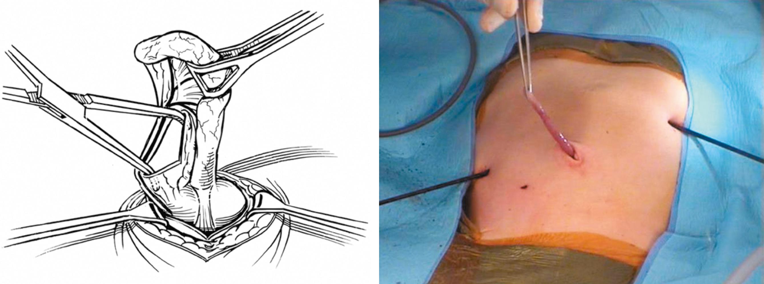 Fig. 7-9, Extracorporeal appendectomy is possible and eliminates the need for a large port for the endoscopic stapler. The appendix is grasped with one of the intracorporeal instruments and brought into view through the umbilical fascial defect, where it is grasped and exteriorized, and an extracorporeal appendectomy is performed.