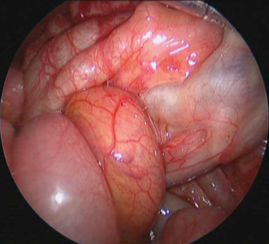 Fig. 7-10, At laparoscopy, a midgut volvulus is noted. The bowel appears healthy. The operation was converted, and an open Ladd procedure was performed.