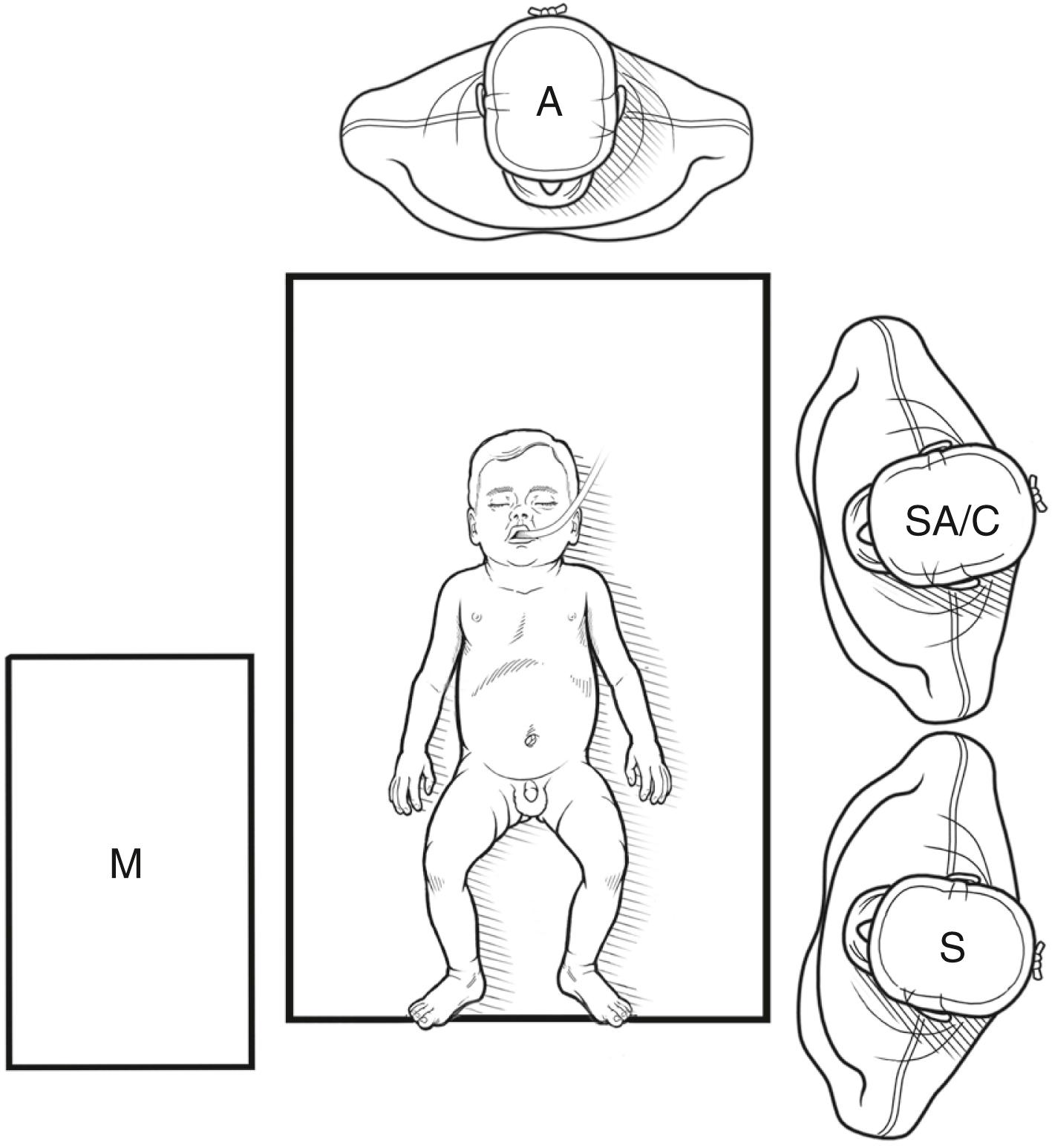 Figure 9-1, For laparoscopic reduction of an ileocolic intussusception, the patient is positioned supine. The patient is secured to the operating table so that the table can be moved into several positions during the operation, thus aiding the surgeon’s exploration of the abdomen. The surgeon (S) and a surgical assistant/camera holder (SA/C) stand on the patient’s left side. The assistant can be situated on either side of the surgeon depending on the location of the intussusception. The monitor (M) is positioned across from the surgeon on the patient’s right side, so that the area of dissection is in line between the telescope attached to the camera and the monitor. The scrub nurse can be positioned at the discretion of the surgeon but usually is situated at the foot of the bed. A, anesthesiologist.