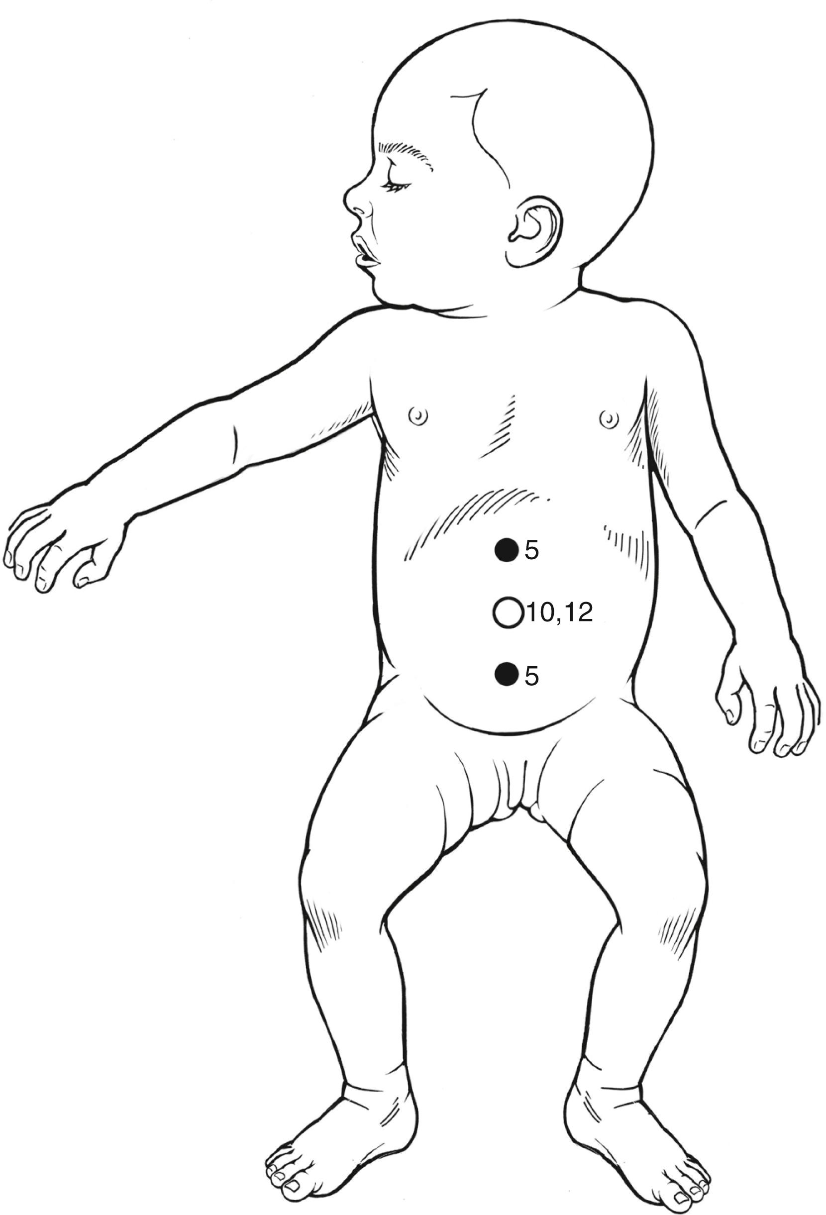 Figure 9-2, Our traditional three-port placement for a laparoscopic intussusception operation is depicted. Depending on the length and location of the intussusceptum, the cannula positions may need to be modified. Currently we have transitioned to a single-incision approach for these patients using a proprietary single-incision port at the umbilicus and extra ports only as needed.