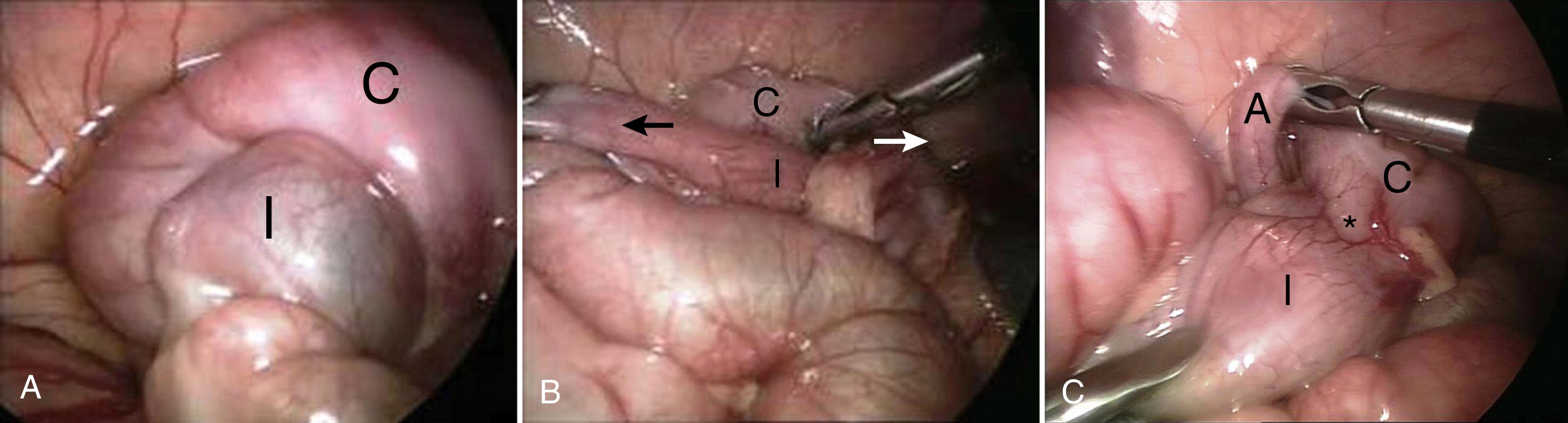 Figure 9-3, This infant presented with an intussusception that could not be reduced. A, The ileum (I) is seen telescoped into the cecum (C) . B, During operative reduction, the ileum (I) is gently retracted proximally (black arrow) , while the edge of the cecum (C) is “rolled” distally (white arrow) over the intussusceptum. C, After successful reduction , the terminal ileum (I) is completely visible as it extends to the ileocecal junction (asterisk) in continuity with the cecum (C) . Traditionally, the appendix (A) was removed concomitantly. However, we feel it can be left in situ if it appears macroscopically normal.