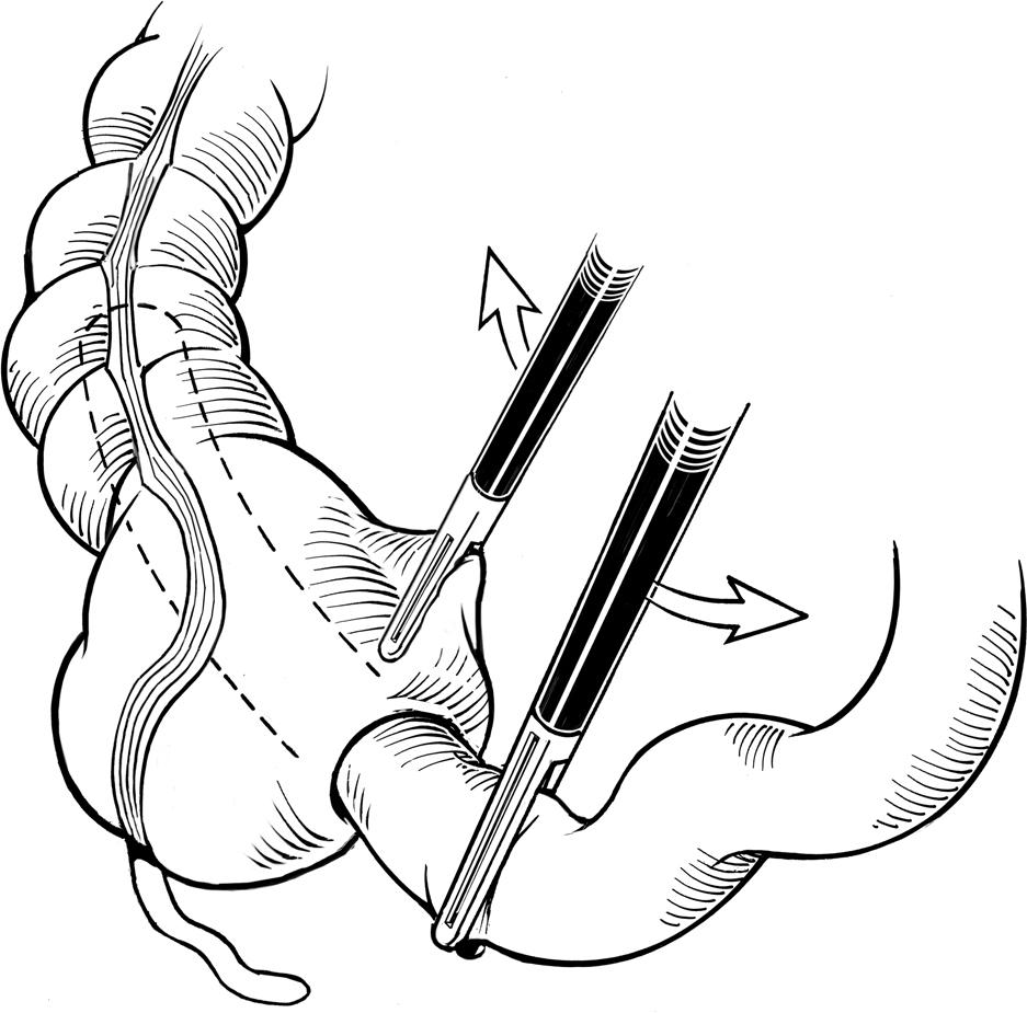 Figure 9-4, In this schematic drawing, the intussuscepted small bowel is grasped with a Babcock or another atraumatic clamp. It is best to completely grasp the entire segment of the small bowel that is intussuscepted into the colon so that the bowel is not torn in the attempt to reduce the intussusception. A larger clamp (5 mm) is therefore often advantageous. The cecum is then pushed away from or rolled over the small bowel with an atraumatic grasping forceps in the surgeon’s left hand.
