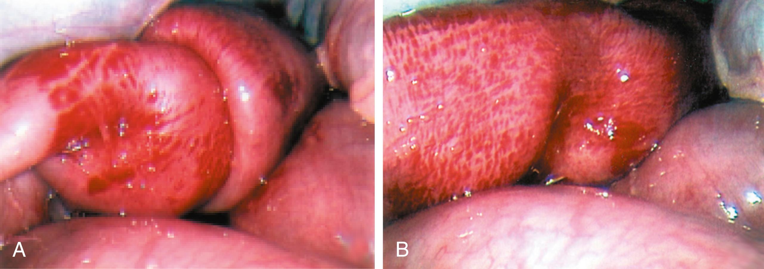 Figure 9-5, A, The ileoileal intussusception that remained after reduction of the ileum from the colon is seen in this patient with an ileocolic intussusception. B, The ileoileal portion has been completely reduced. Note the edema and induration in the wall of the small bowel in both photographs.