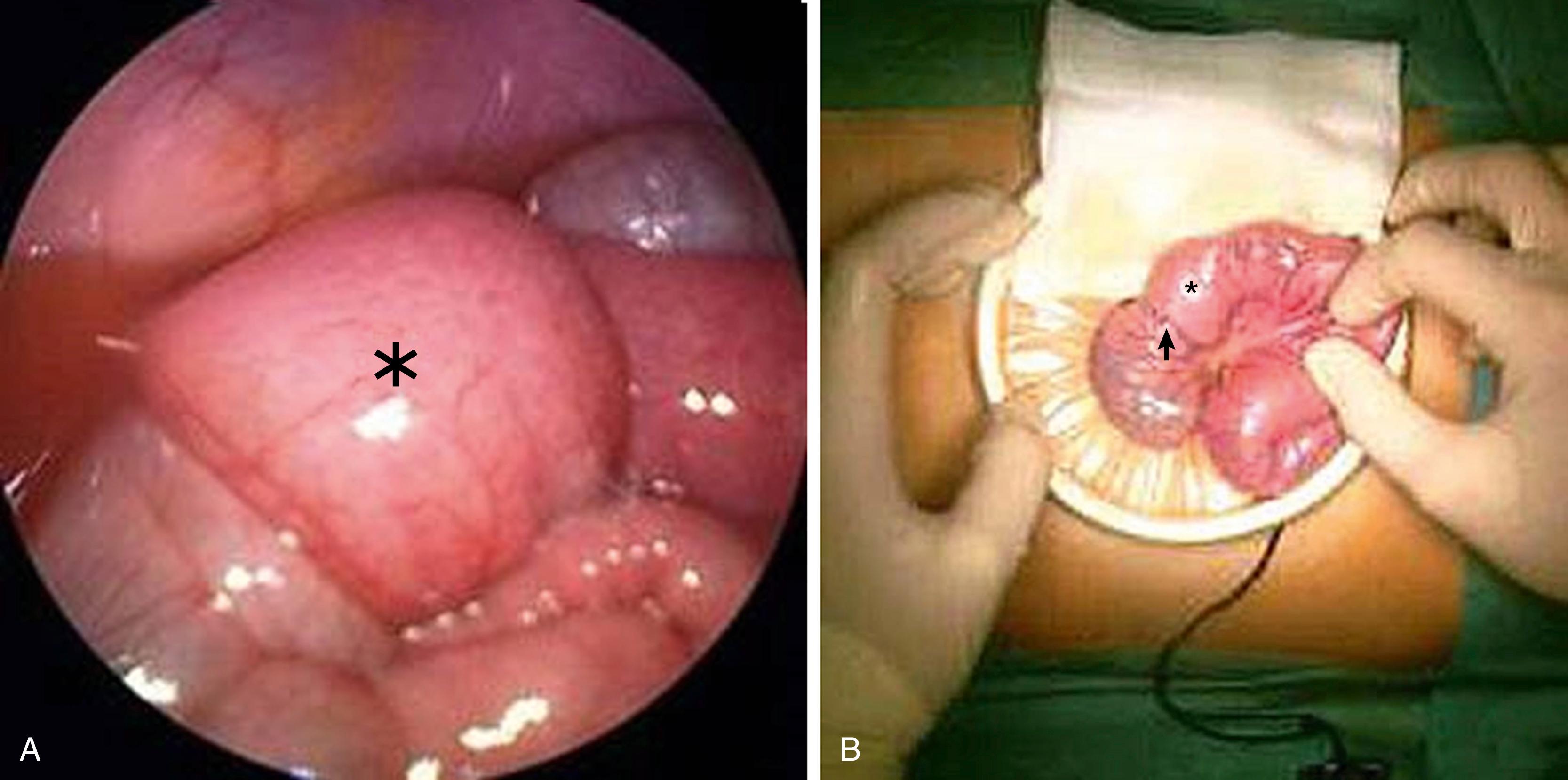 Figure 9-6, This intraoperative view shows an ileoileal intussusception (asterisk) that did not resolve spontaneously. A, Upon laparoscopic exploration, a mass (asterisk) was palpable in the lumen, which suggested a lead point. B, After exteriorization through the umbilical port site and manual open reduction, the intussusception ( arrow pointing to intussusceptum, asterisk marking intussuscipiens) was reduced. In the antimesenteric wall of the intussusceptum, an inverted Meckel diverticulum was found and resected.