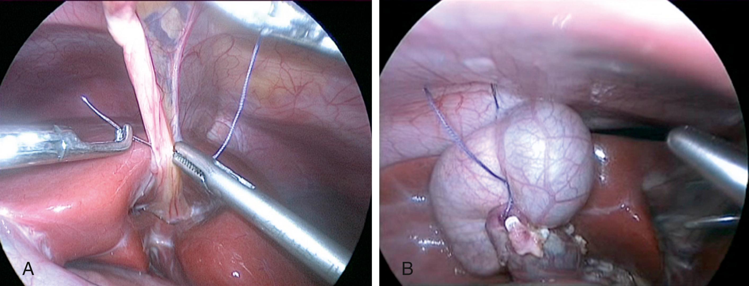 Fig. 23-2, A , A suture has been placed through the round ligament and will be exteriorized in the epigastrium to elevate the liver to expose the choledochal cyst. B , A second traction suture has been positioned at the junction of the distal cystic duct and gallbladder fundus to further elevate the liver anteriorly for improved visualization of the hepatic hilum.