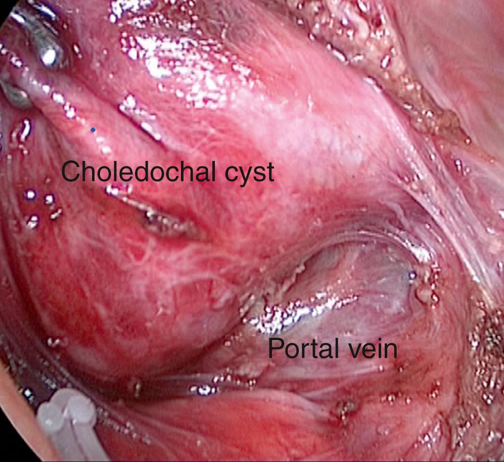 Fig. 23-3, This laparoscopic view shows the cyst being separated from the hepatic artery and portal vein posteriorly. Meticulous dissection is needed for this part of the operation.