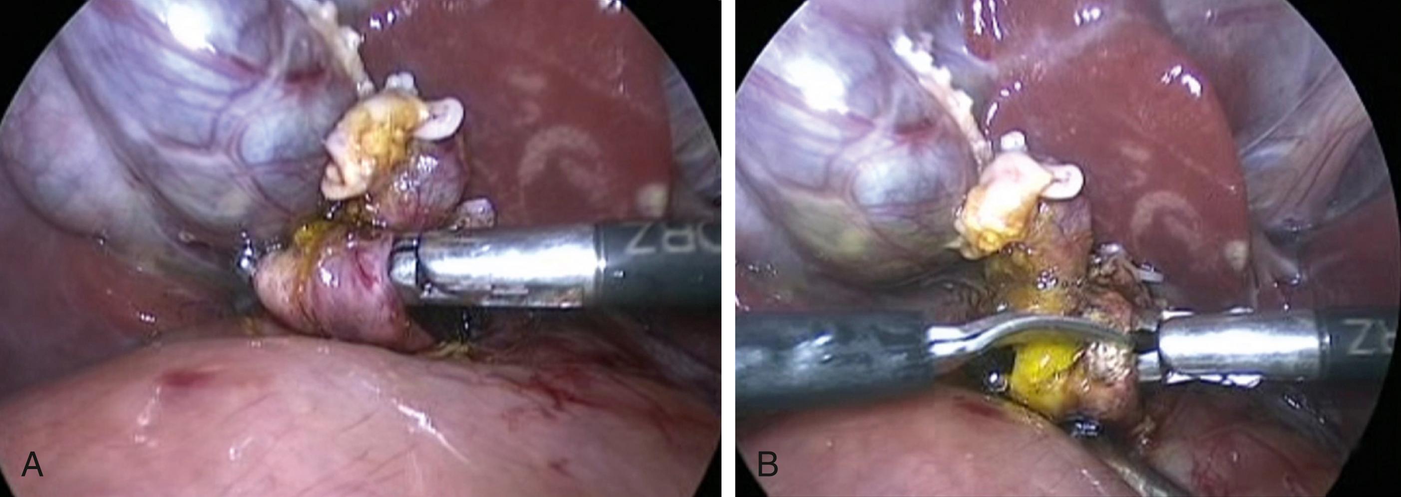 Fig. 23-4, A, A dissecting instrument has been passed through the space between the posterior wall of the cyst and the portal vein. B, The cyst is now being divided at this site.