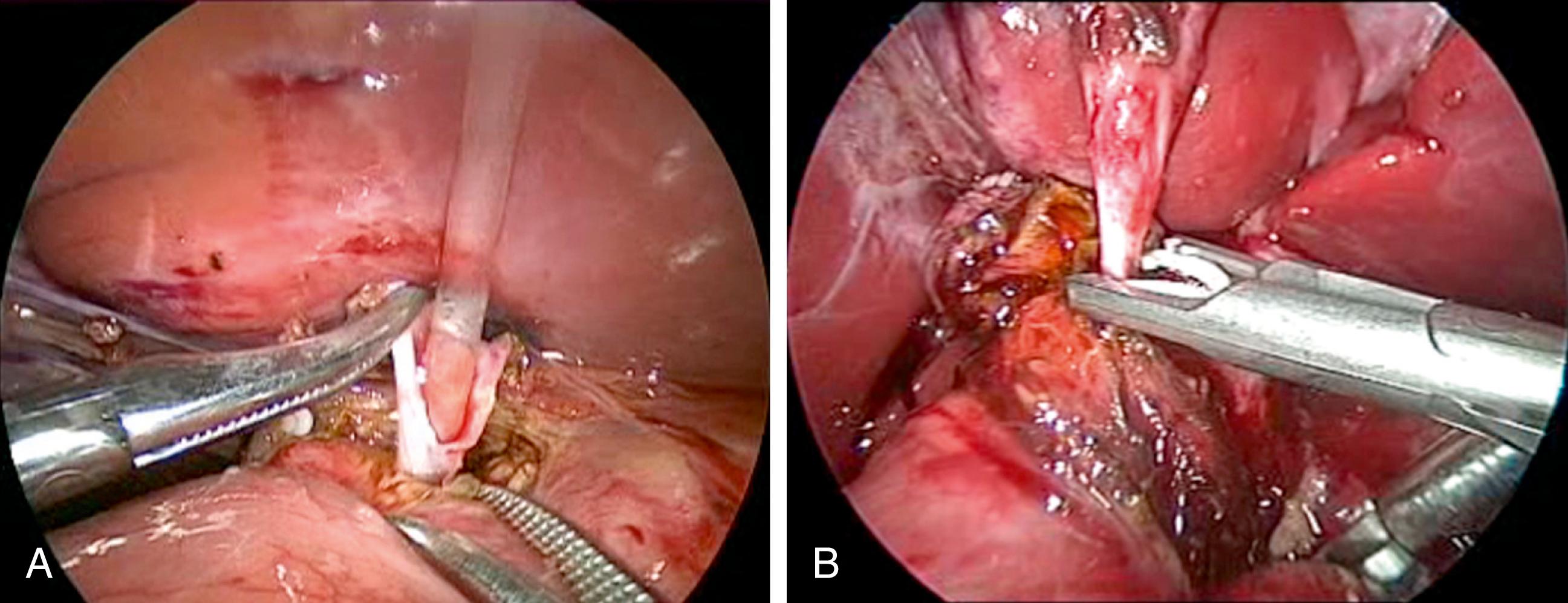 Fig. 23-5, A, After opening the inferior part of the cyst to identify the orifice of the common biliopancreatic channel, a small catheter is inserted into the common channel for irrigation and elimination of any protein plugs. B, After the common channel has been irrigated, the distal choledochal cyst is being ligated with an endoscopic clip and will subsequently be divided at the level of the orifice of the common channel.