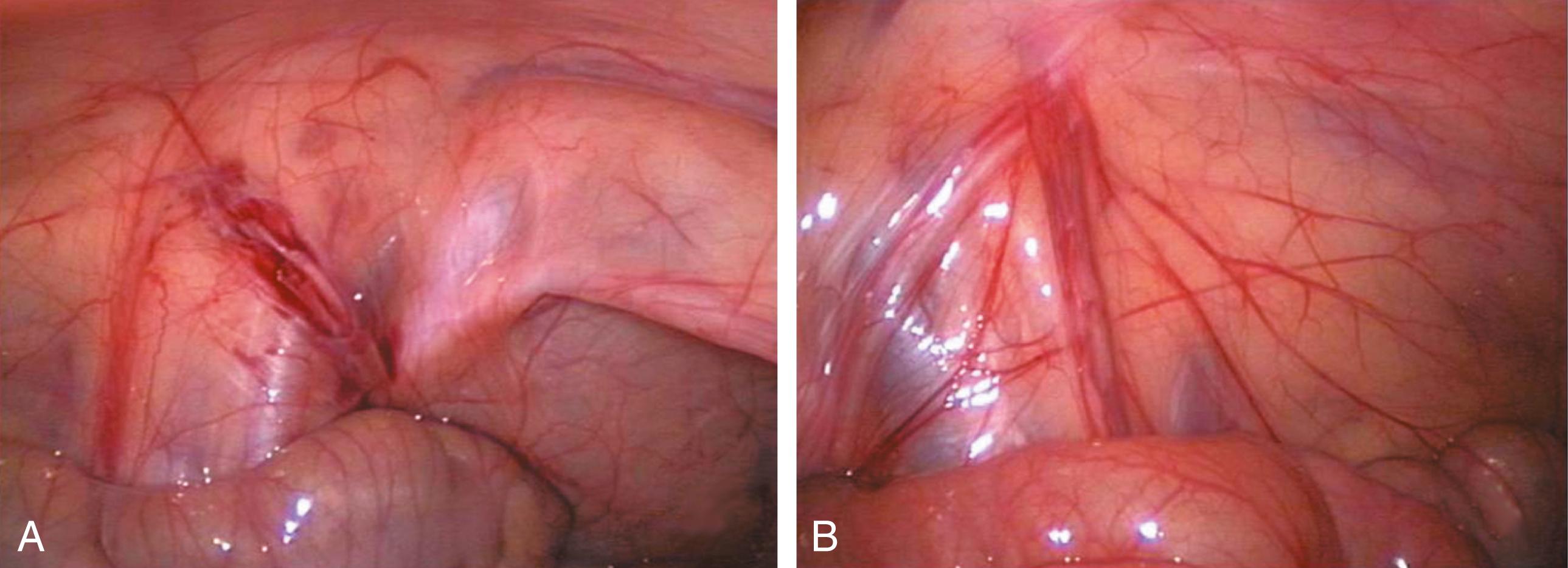 Fig. 20-2, The laparoscopic findings in two different boys with a nonpalpable testis. A, The vas deferens and testicular vessels in this patient end blindly in the retroperitoneum. The internal ring is closed. In this very unusual situation, inguinal exploration is not necessary. B, In the more common scenario, the testicular vessels and vas deferens enter the inguinal canal. There is no evidence for a patent processus vaginalis. The vessels and vas deferens appear to be of relatively normal caliber. In this situation, inguinal exploration is necessary.