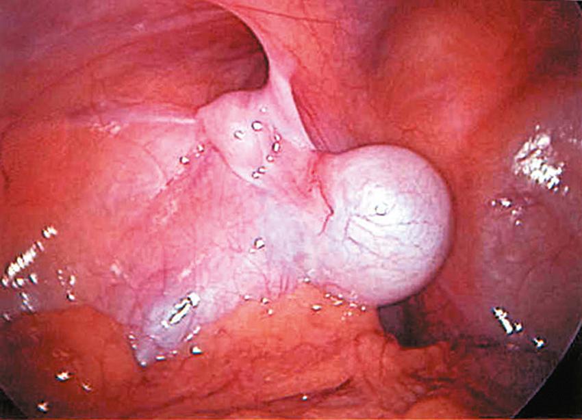 Fig. 20-3, In this patient, a left intra-abdominal testis is lying inside the internal ring, which is associated with a patent processus vaginalis.