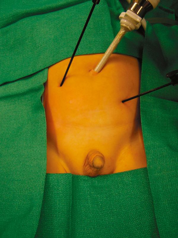 Fig. 20-4, After diagnostic laparoscopy through a 5-mm umbilical cannula, if ligation and division of the testicular vessels are required, two accessory 3-mm instruments are introduced into the abdominal cavity using the stab incision technique. The surgeon stands on the side opposite the nonpalpable testis. Placement of these instruments varies among surgeons.