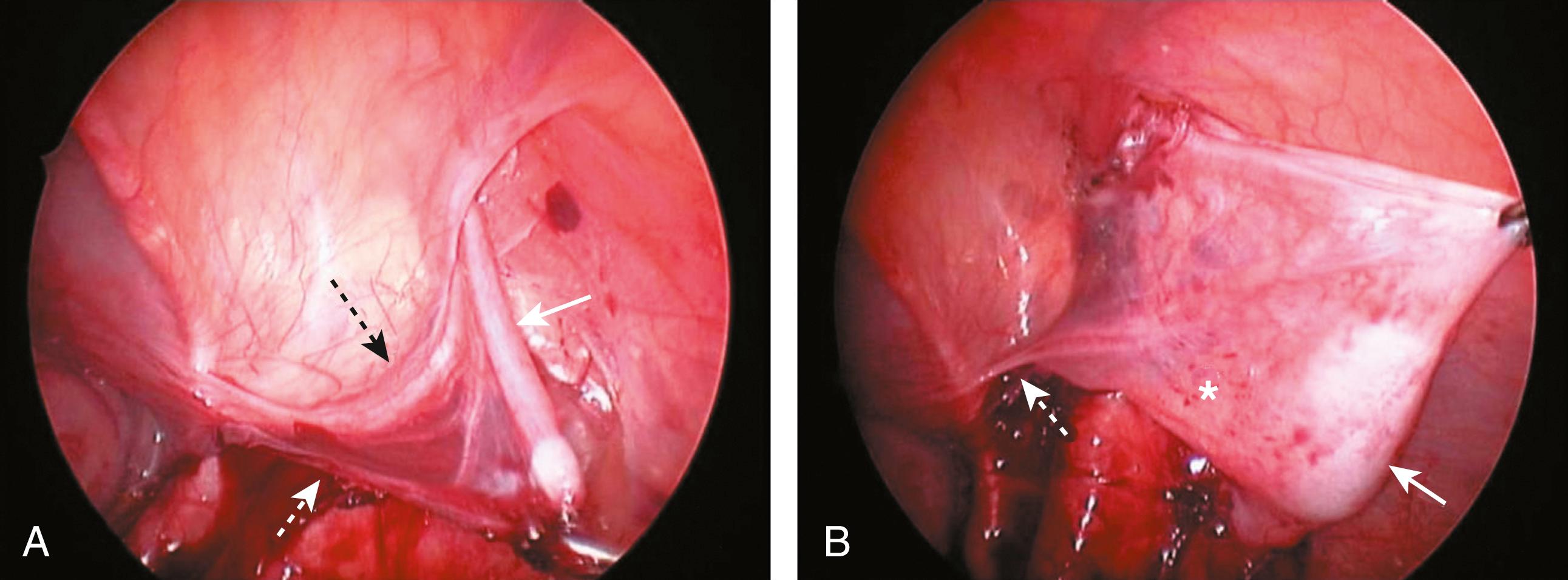 Fig. 20-6, This patient is undergoing a laparoscopic right orchiopexy. A, The inferior portion of the peritoneal flap ( dotted white arrow ) containing the secondary vasculature to the testis is being mobilized. The testis has retracted into the right inguinal canal during this mobilization. The testicular vessels ( solid white arrow ) were divided previously and are retracted into the inguinal canal with the testis. The vas deferens is marked with a dotted black arrow . B, The right testis ( solid arrow ) is now being mobilized. The peritoneum ( asterisk ), lying between the testis and vas deferens ( dotted arrow ), has been left intact. It is through this peritoneum that the accessory vasculature to the testicle lies.