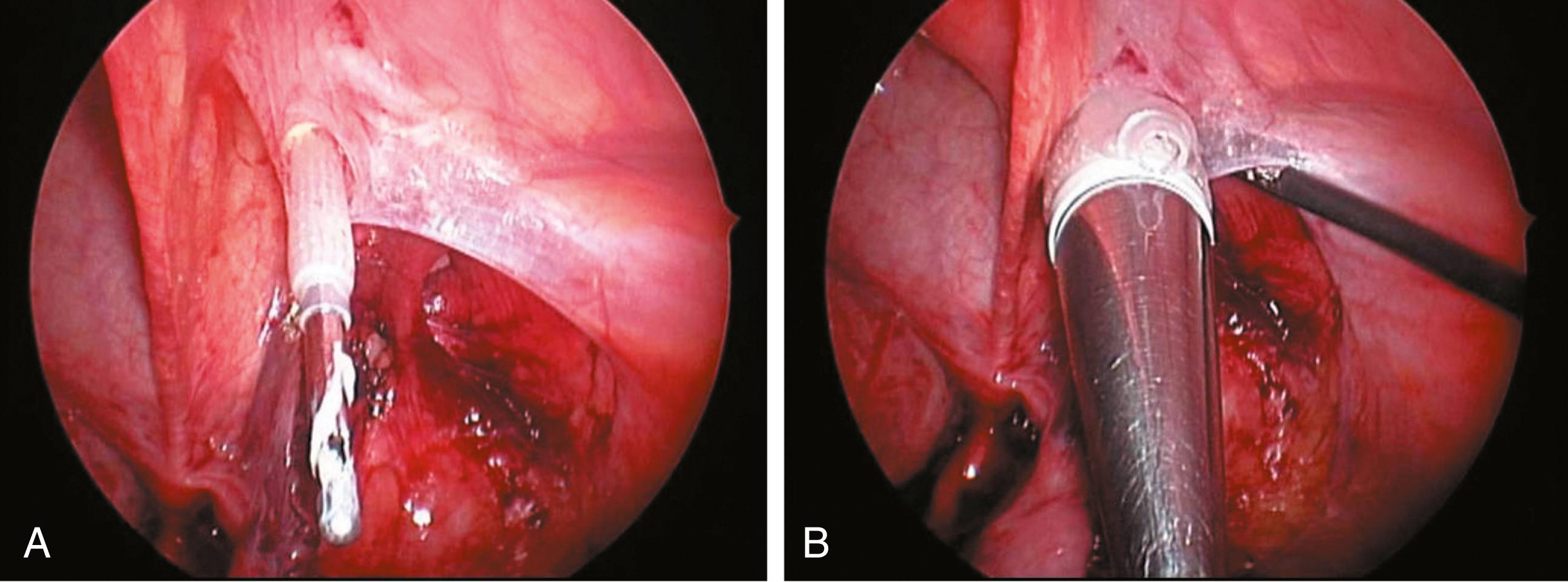 Fig. 20-7, A, After mobilization of the testis and its secondary vasculature, a Veress needle and attached sheath are placed through an incision in the scrotum and directed over the pubic tubercle into the pelvis. B, The Veress needle has been removed. A 10-mm cannula with a blunt-tip trocar has been introduced through the expandable sheath and into the peritoneal cavity.