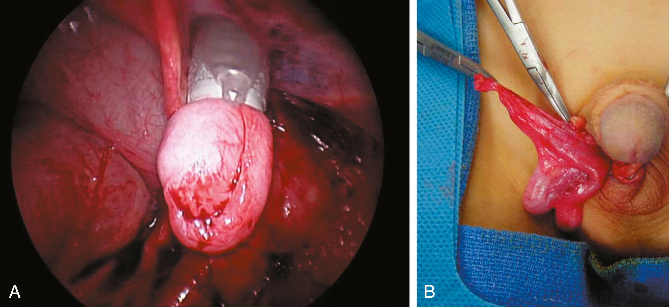 Fig. 20-8, A, The gubernaculum has been grasped with forceps introduced through the 10-mm cannula, and the testis is being withdrawn through the 10-mm cannula. Often, it is not possible to place the testis entirely into the 10-mm cannula. B, After removal of the cannula and with a secure hold on the gubernaculum, the testis is delivered over the pubic tubercle and into the right hemiscrotum.