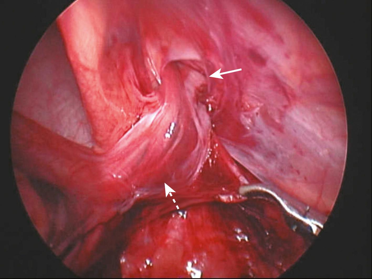 Fig. 20-9, The testis and secondary vasculature and the vas deferens have been transposed over the right pubic tubercle and into the right hemiscrotum. Note the opening ( solid arrow ) in the peritoneum and lower abdominal wall as these structures ( dotted arrow ) exit the abdominal cavity.