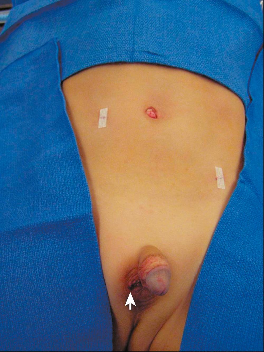 Fig. 20-10, In this patient who has undergone a laparoscopic right orchiopexy, the two stab incisions have been closed with Steri-Strips, and the umbilical fascia and skin have been closed with absorbable suture. Note the incision in the right hemiscrotum ( arrow ).