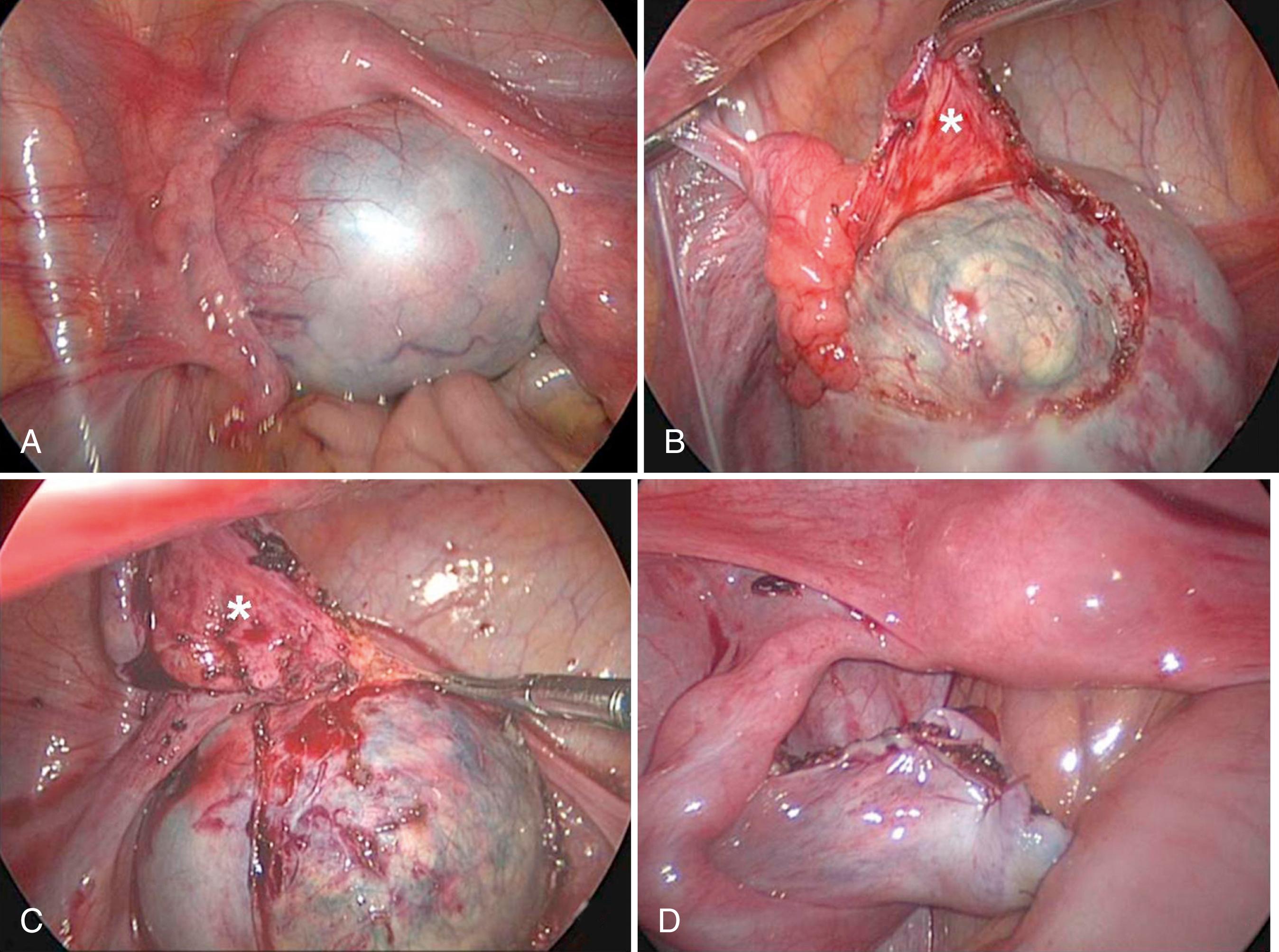 Fig. 21-1, A 14-year-old girl presented with abdominal pain. Ultrasonography and computed tomography showed calcifications within this left ovarian mass ( A ), indicating it was a likely ovarian teratoma. B, Laparoscopic excision of the teratoma was initiated by incising the cortex overlying the teratoma and peeling back the normal ovarian parenchyma ( asterisk ). C, The ovarian parenchyma ( asterisk ) has almost been completely stripped from the teratoma. D, The ovarian parenchyma was then approximated after the mass was excised and removed. The teratoma was placed in an endoscopic retrieval bag and exteriorized through the umbilicus after some morcellation. Histologic examination showed it to be a benign teratoma.