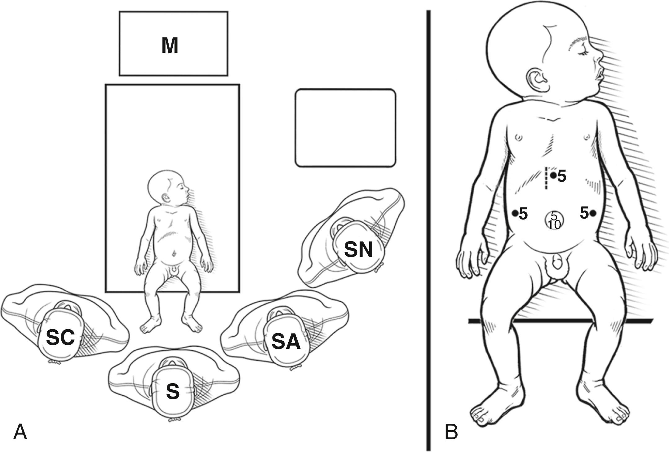 Fig. 22-1, A, The baby is positioned at the foot of the operating table with the operating surgeon (S) standing at the infant’s feet. A scopist (SC) is situated slightly behind and to the left of the operating surgeon, and an assistant (SA) is positioned on the patient’s left to assist with exposing the porta hepatis and the anastomosis. The scrub nurse (SN) stands to the left of the patient and the anesthetist is located near the patient’s head. A single monitor is (M) positioned at the patient’s head, facing the operating personnel. B, The five ports are situated as depicted on this schematic. A 10-mm and 5-mm cannula are introduced inside the EZ access with the LAP PROTECTOR device. The other ports are 5 mm in size. A Nathanson liver retractor (dotted line) is also helpful for the laparoscopic Kasai procedure.