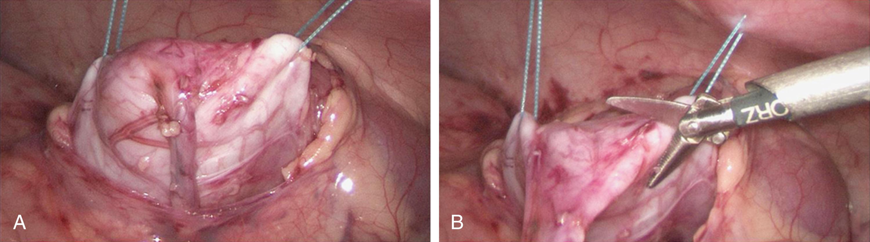 Fig. 28-1, After mobilization and sufficient exposure to the dilated renal pelvis secondary to ureteropelvic junction obstruction, two transabdominal hitch sutures are placed to help further expose the pelvis (A) . B, The initial step in resection of the pelvis is being initiated between these two hitching sutures.