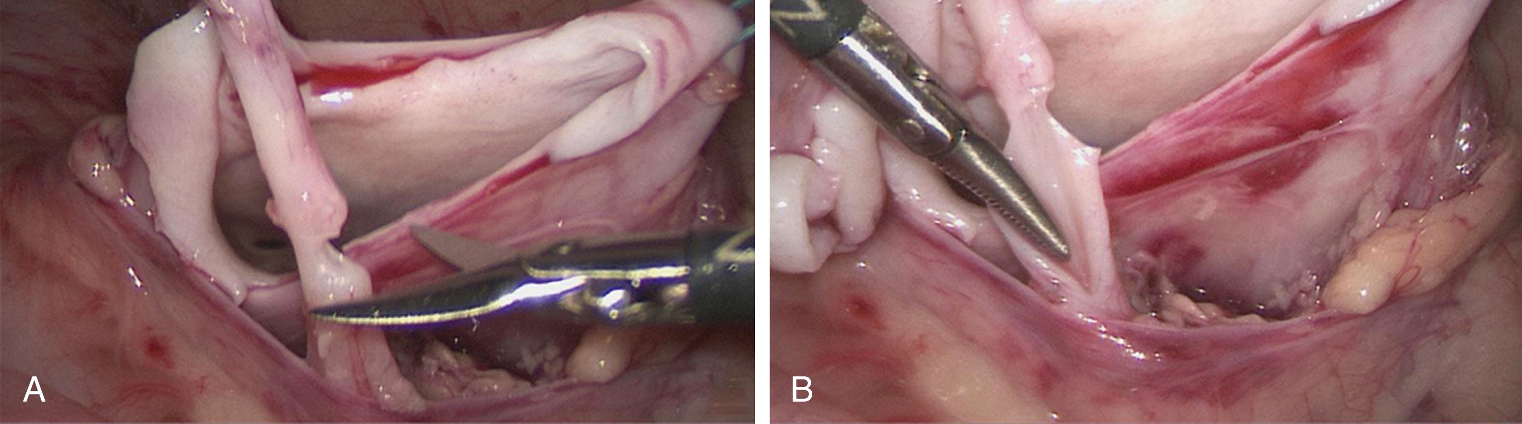 Fig. 28-2, A, After resection of the dilated renal pelvis, the ureter is incised well below the ureteropelvic junction but is not completely transected. It is then spatulated on its lateral aspect (B) to provide a sufficient length of ureteral wall for achieving a patent side-to-side anastomosis.