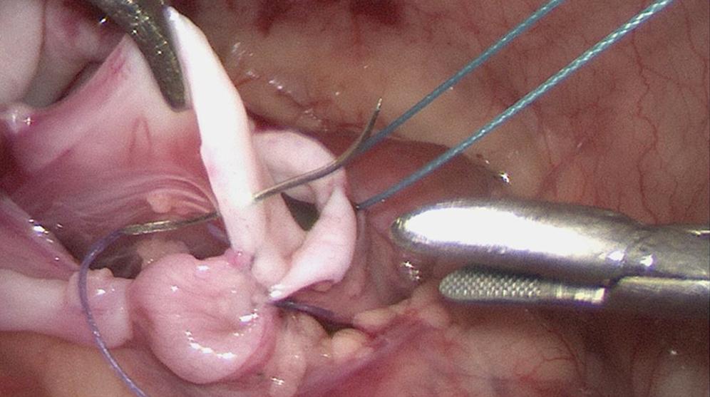 Fig. 28-3, A side-to-side anastomosis between the spatulated ureter and remaining renal pelvis is being performed.