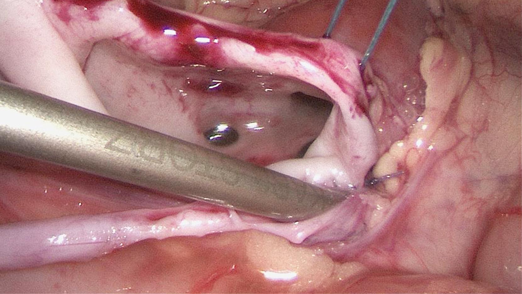 Fig. 28-4, After completing the back wall of the side-to-side anastomosis, the patency of the anastomosis is checked before securing the front wall.