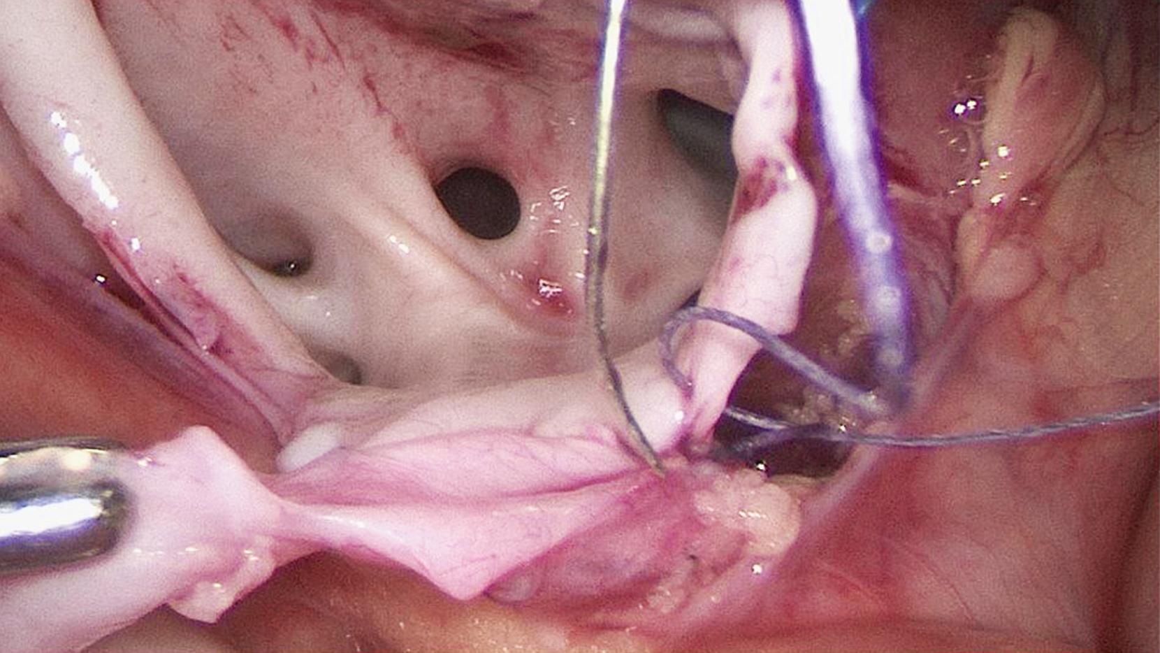 Fig. 28-5, The anterior anastomosis is being performed. Note the “no touch” technique on the ureter as part of the renal pelvis and proximal ureter are being used as a handle during the anastomotic suturing. Such an approach will avoid grabbing and injuring the ureter during suturing.