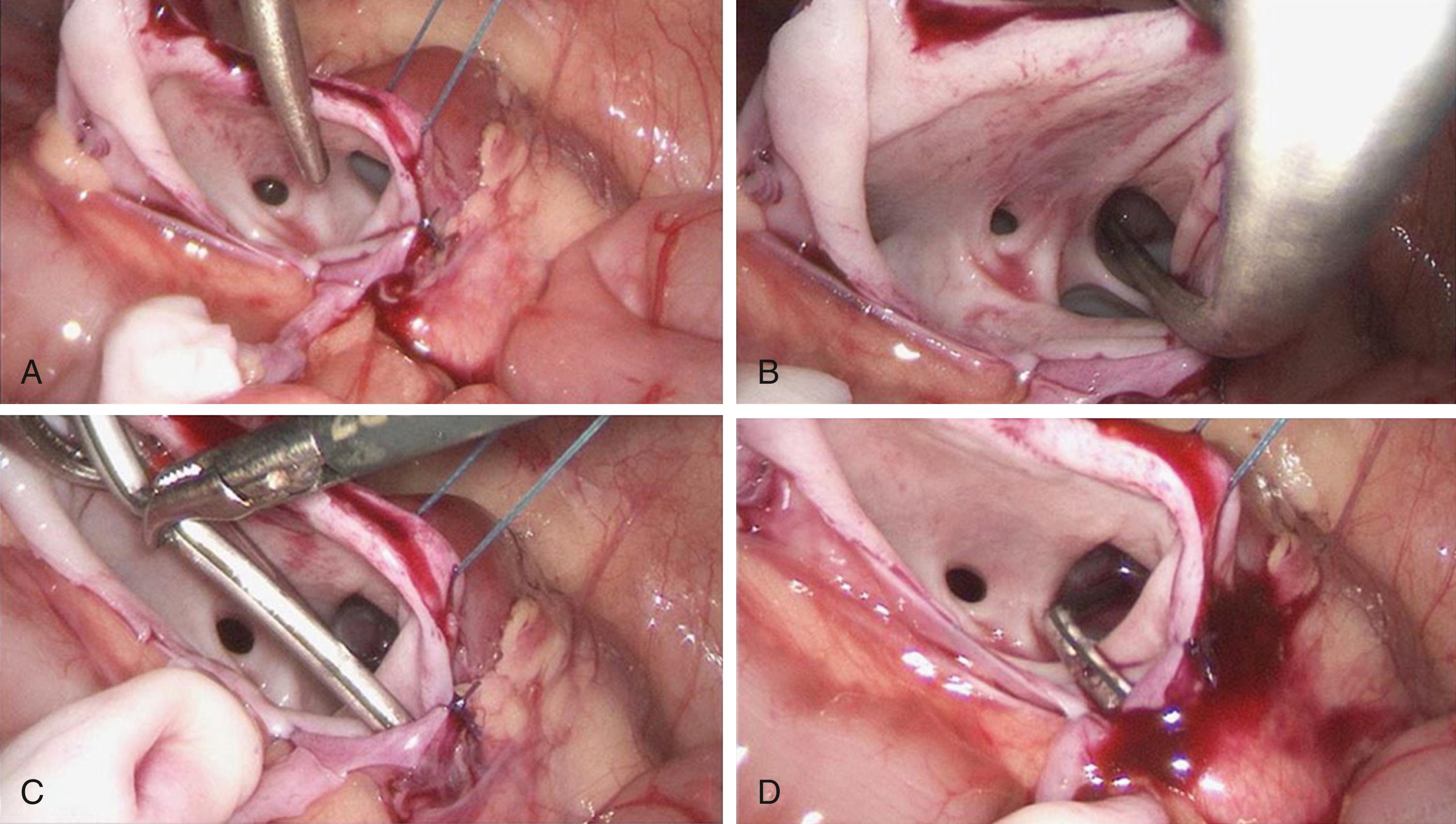 Fig. 28-6, These four photographs depict our preferred technique for placing a stent through the pelvic-ureteral anastomosis following resection of the dilated ureteropelvic junction. A, The stent has been introduced transabdominally using a curved custom-made device. It is then brought into the open renal pelvis and through an identified calyx (B), and punctured out through the rental parenchyma and the lateral abdominal wall. The other end of the catheter is then pulled into the abdomen and threaded into the distal ureter (C, D) .