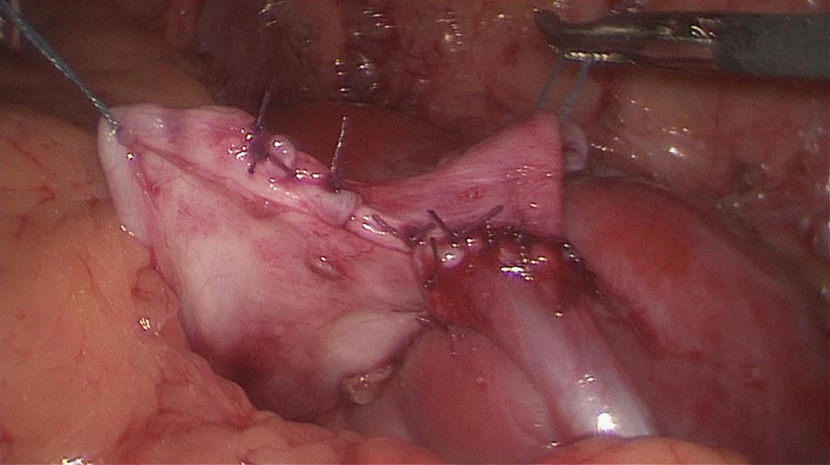 Fig. 28-7, Following placement of the stent through the pelvic-ureteral anastomosis, the remaining open pelvis is closed using a running suture or “Z-tie” single interrupted suture.