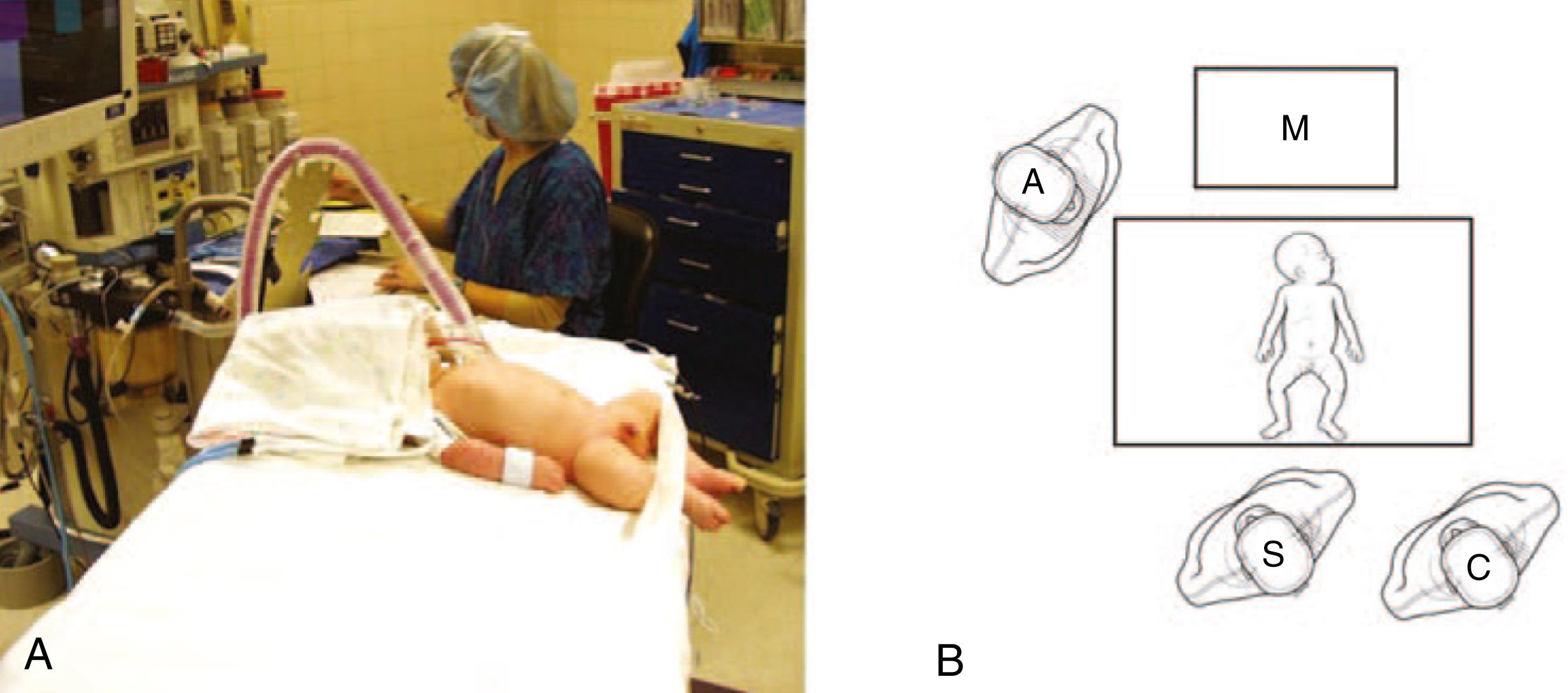 Fig. 5-1, A, The infant is positioned transversely across the operating table. A red rubber catheter has been inserted to distend the stomach following the myotomy. B, Operating personnel are depicted. The surgeon (S) stands at the foot of the patient. The camera holder (C) is usually positioned to the surgeon’s right. The monitor (M) is above the patient. A, anesthesiologist.