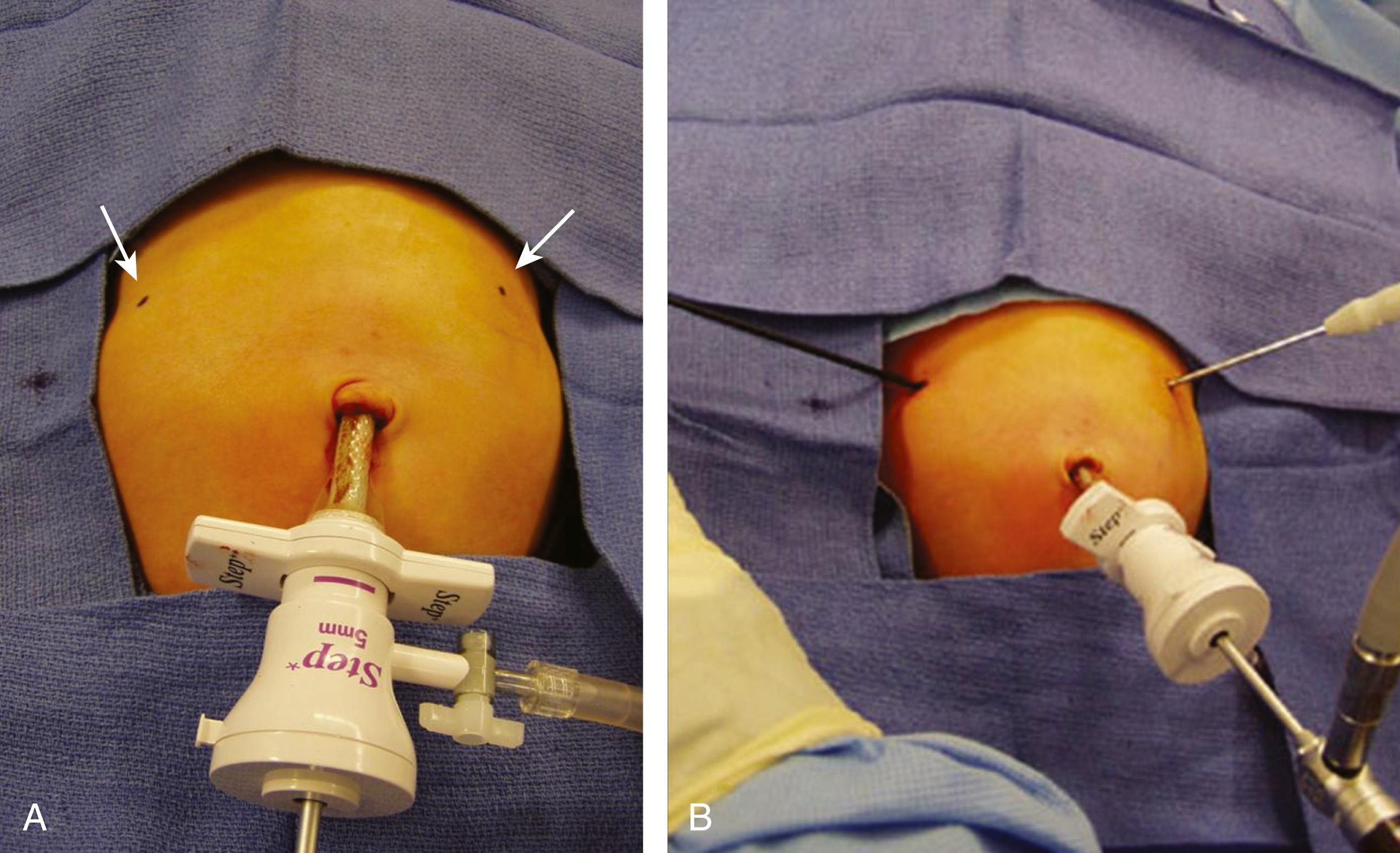 Fig. 5-2, A, The umbilical cannula and telescope have been introduced. The sites for insertion of the instruments in the epigastrium are marked ( arrows ). B, The 3-mm instruments have been inserted using the stab incision technique.