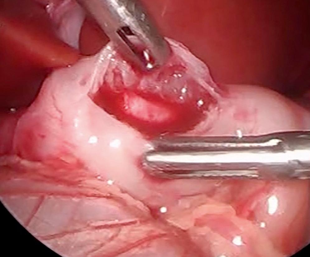 Fig. 5-5, In this operative photograph, the surgeon has grasped both edges of the pyloromyotomy and is rocking the edges back and forth to be sure they move independently, which is an indication of a complete myotomy.