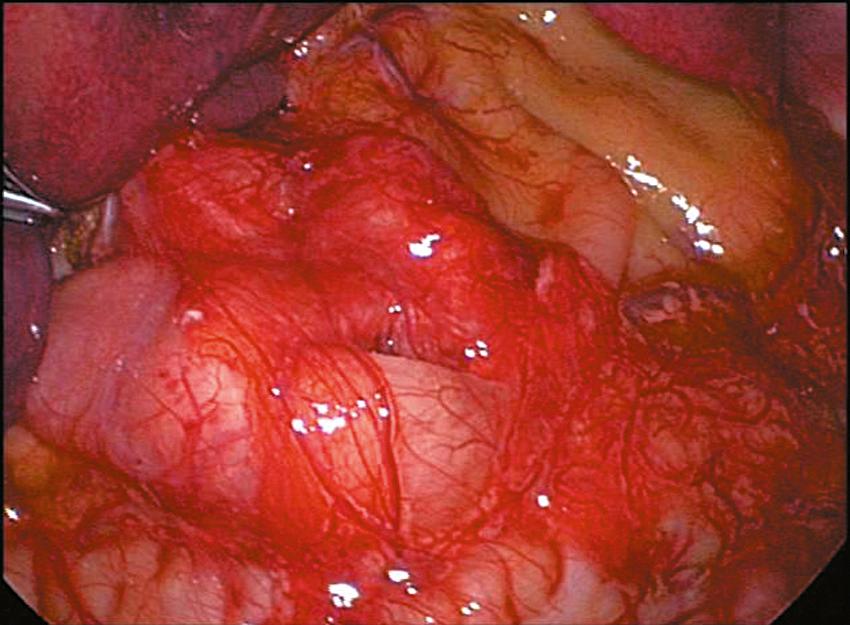 Fig. 5-7, Omentum has been placed over the myotomy in this patient to help with hemostasis.