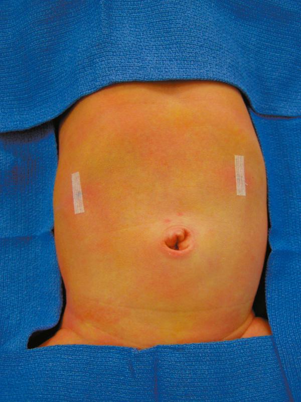 Fig. 5-8, The epigastric incisions have been closed with Steri-Strips. The umbilical fascia and skin have been closed with absorbable sutures.