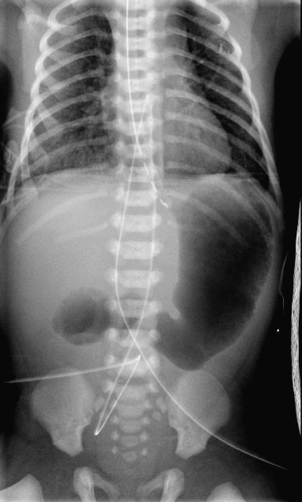 Fig. 6-1, The typical “double bubble” sign is seen in this newborn with duodenal atresia.