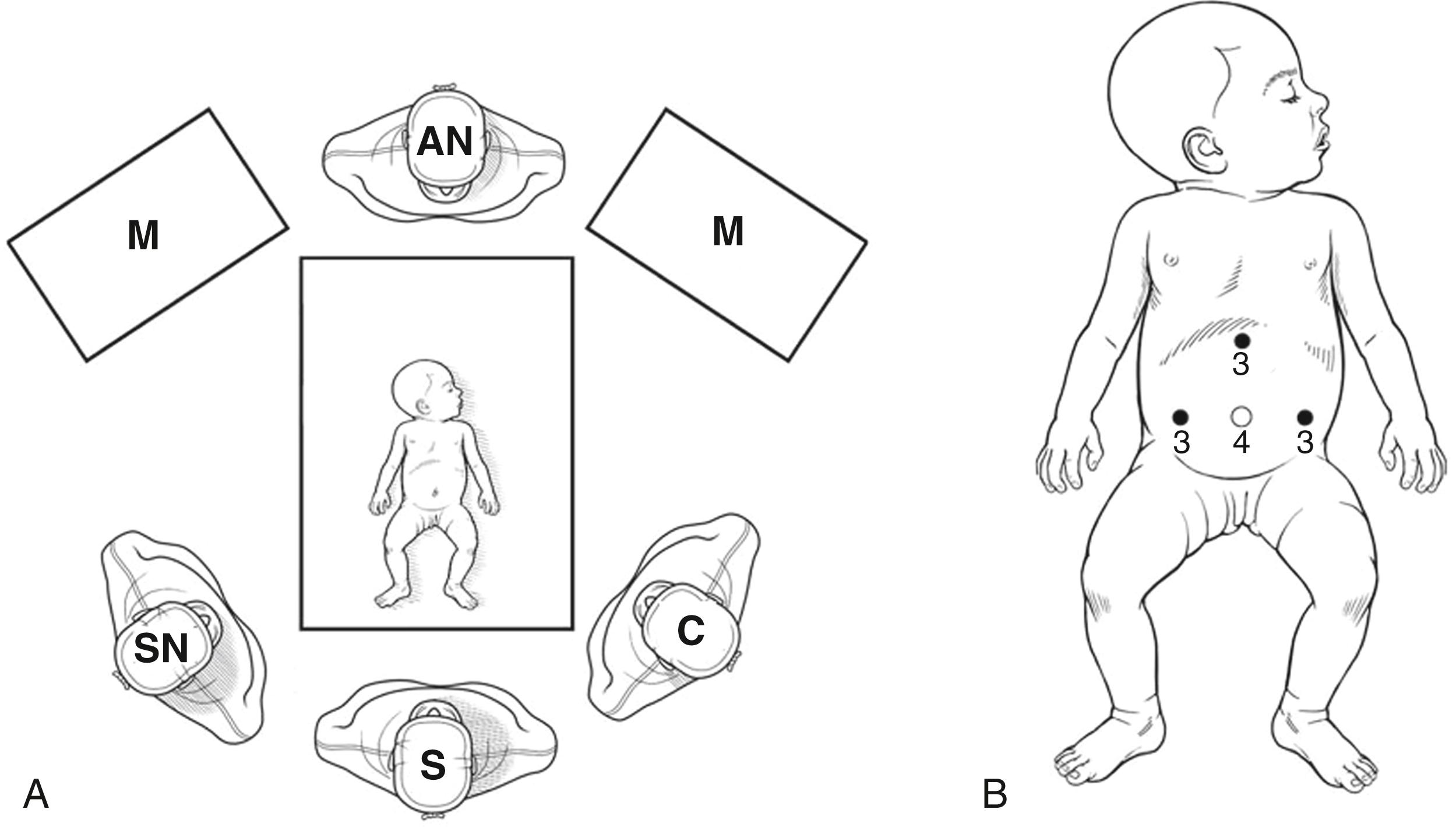 Fig. 6-2, A, The surgeon (S) stands at the foot of the operating table with the camera holder (C) to the surgeon’s left and scrub nurse (SN) to the right. The infant is positioned at the end of the operating table. AN, anesthesiologist; M, monitor. B, The location and size (in millimeters) of the four ports are seen. The 3-mm subxiphoid port is optional for a liver retractor.