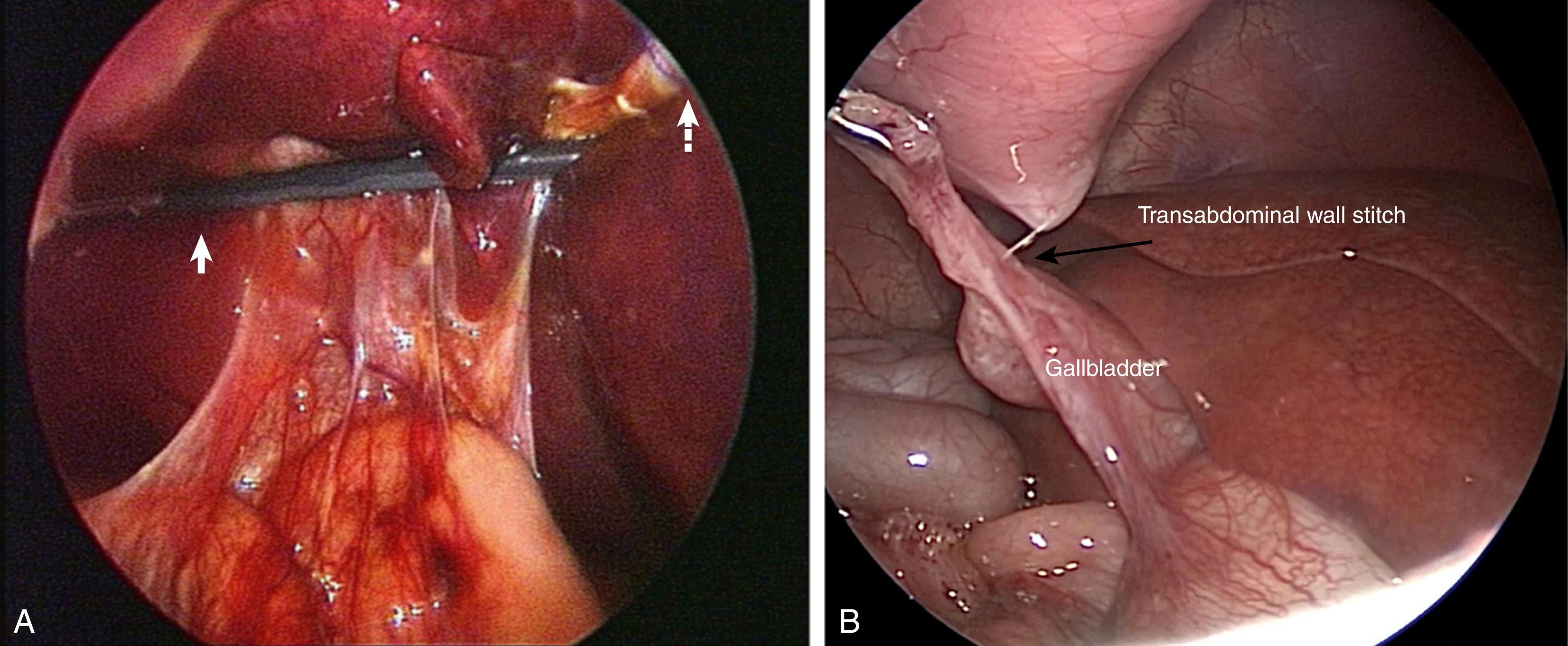 Fig. 6-3, A, The liver is elevated by a transabdominal wall suture, introduced extracorporeally, and then placed underneath the falciform ligament ( dotted arrow ). The right lobe of the liver can be further suspended with an Allis-type forceps ( solid arrow ), which is secured to the lateral peritoneum. B, A stitch has been inserted through the anterior abdominal wall, then through the dome of the gallbladder, and out the abdominal wall to better expose the duodenum.