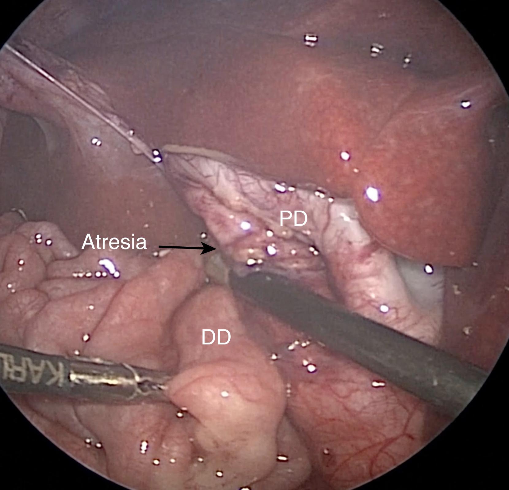 Fig. 6-4, The duodenum has been kocherized. The dilated proximal duodenum (PD) and small-caliber distal duodenum (DD) are seen.