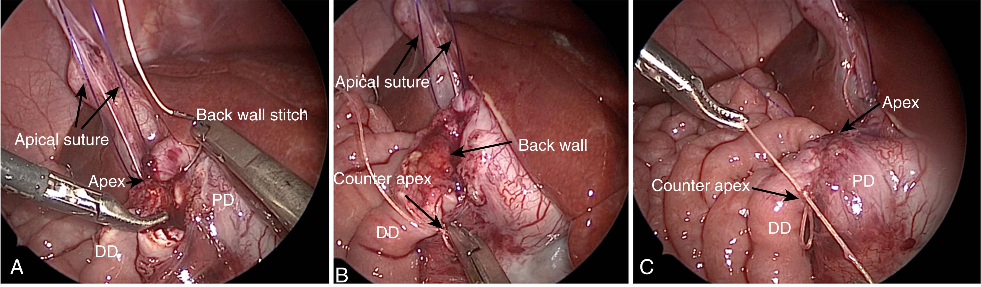 Fig. 6-5, A, The distal duodenum (DD) has been opened longitudinally and the proximal duodenum (PD) has been opened transversely. The apex of the anastomosis has been aligned with a 4-0 PDS suture inserted through the anterior abdominal wall. The back wall of the anastomosis is being performed. B, The back wall suture line has been completed, and the suture has been tied to itself at the counter apex. C, The completed anastomosis is seen.