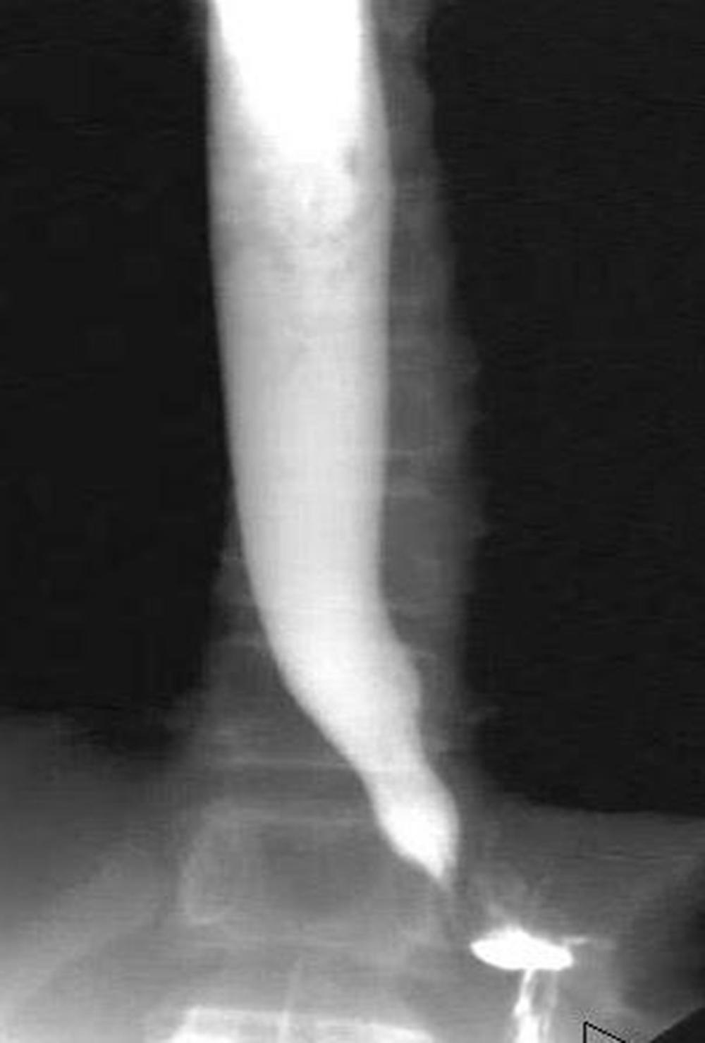 Fig. 3-1, The typical esophagram in a patient with achalasia is seen. The esophagus is dilated and narrows to the bird’s beak appearance at the lower esophageal sphincter.