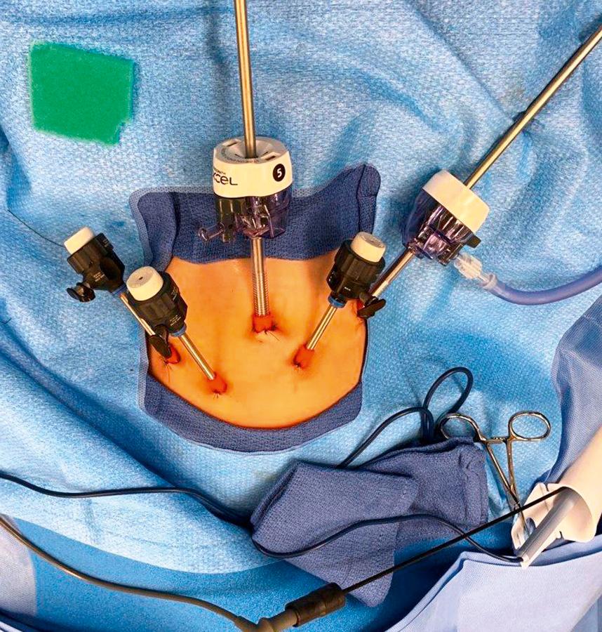 Fig. 3-2, This operative photograph shows the position of the ports for a laparoscopic esophagomyotomy in a young patient.